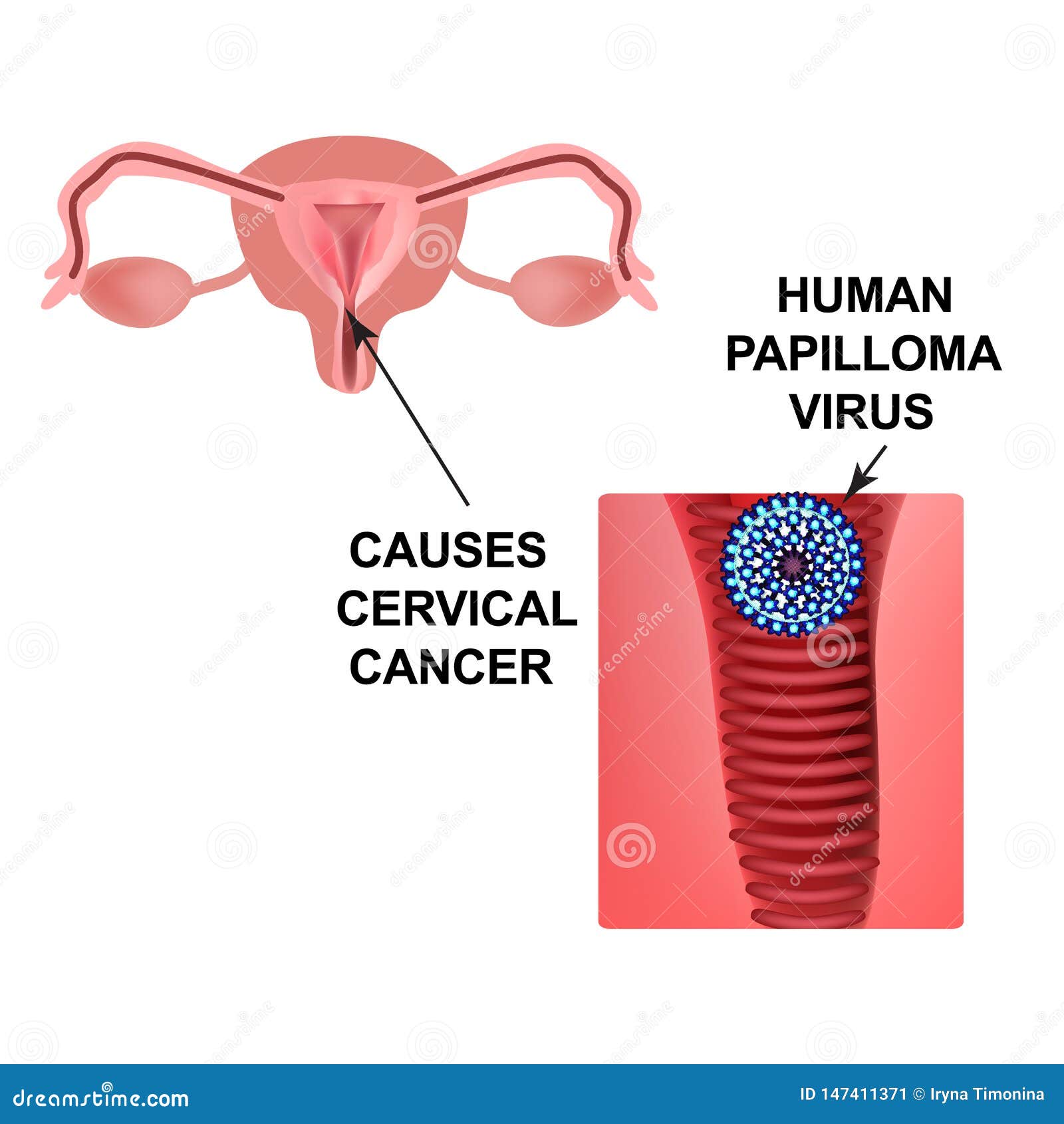 causes du virus papilloma