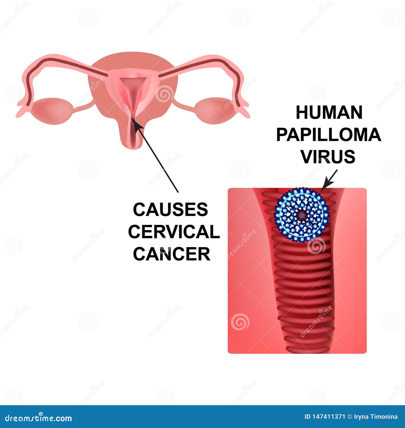 Can human papillomavirus cause genital warts