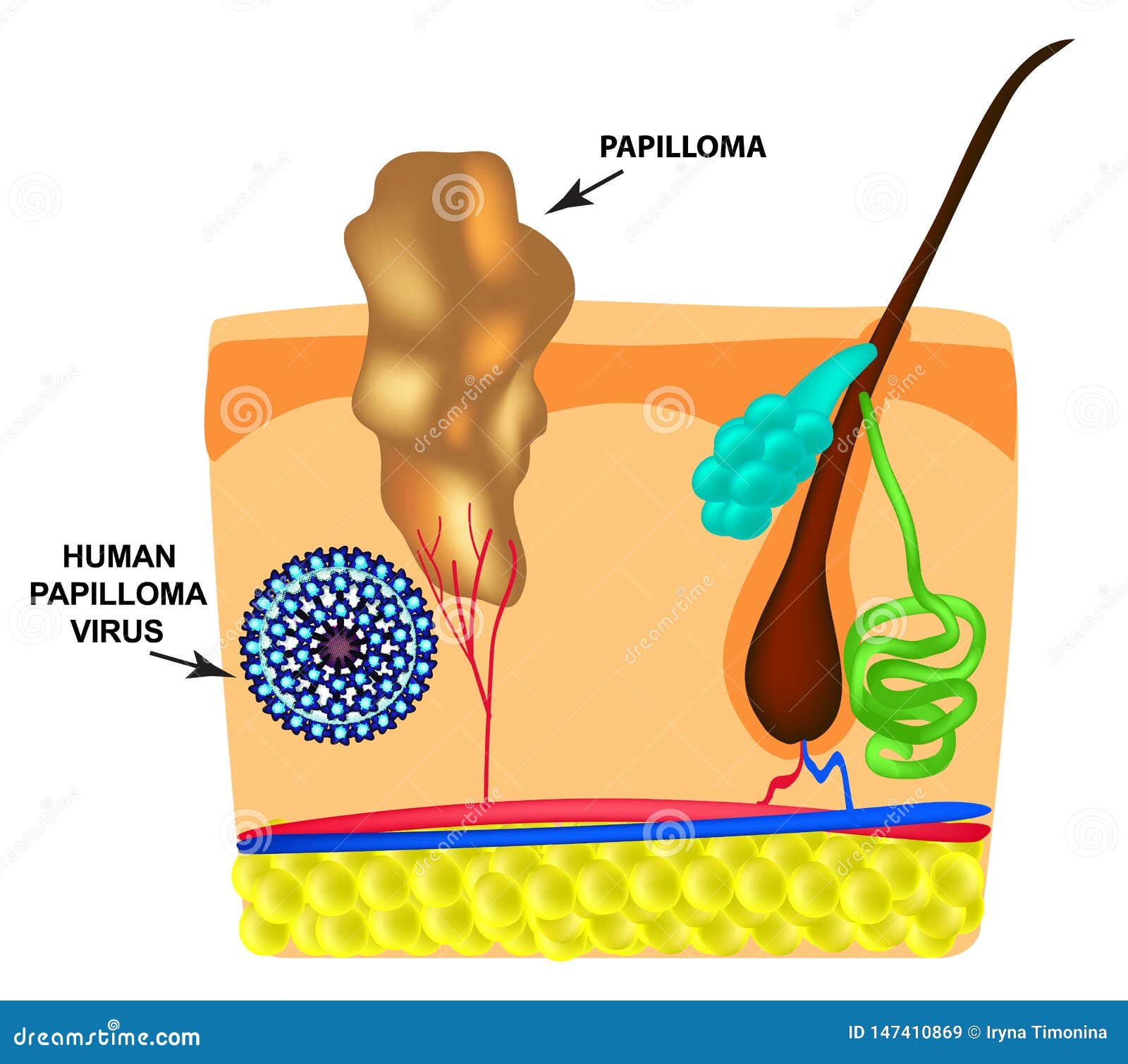 skin papilloma formation