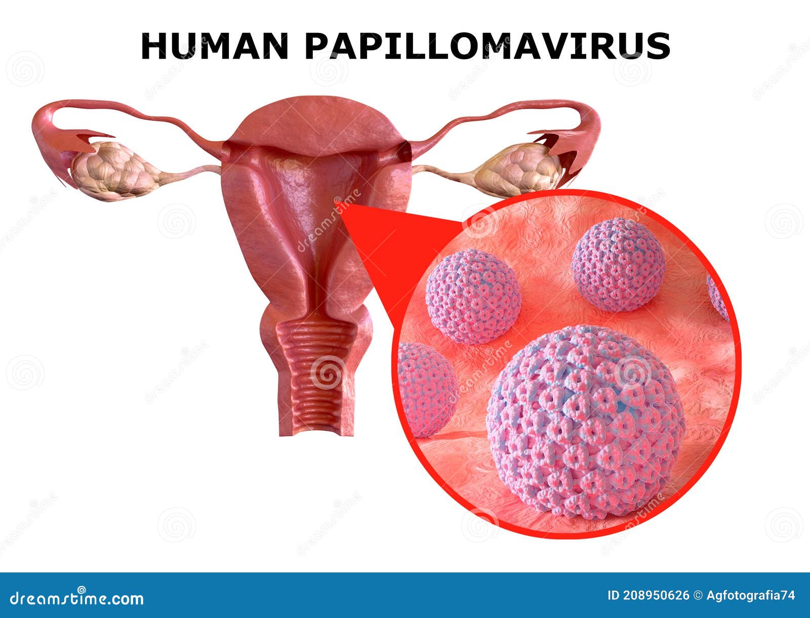 Human papillomavirus infection vs genital warts