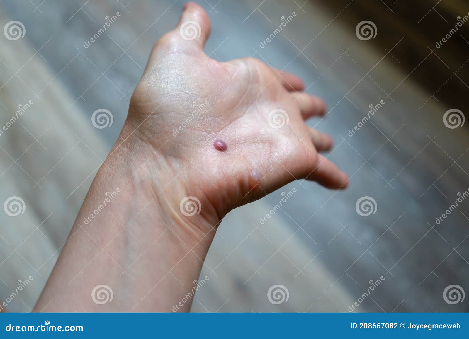human papillomavirus infection on hands