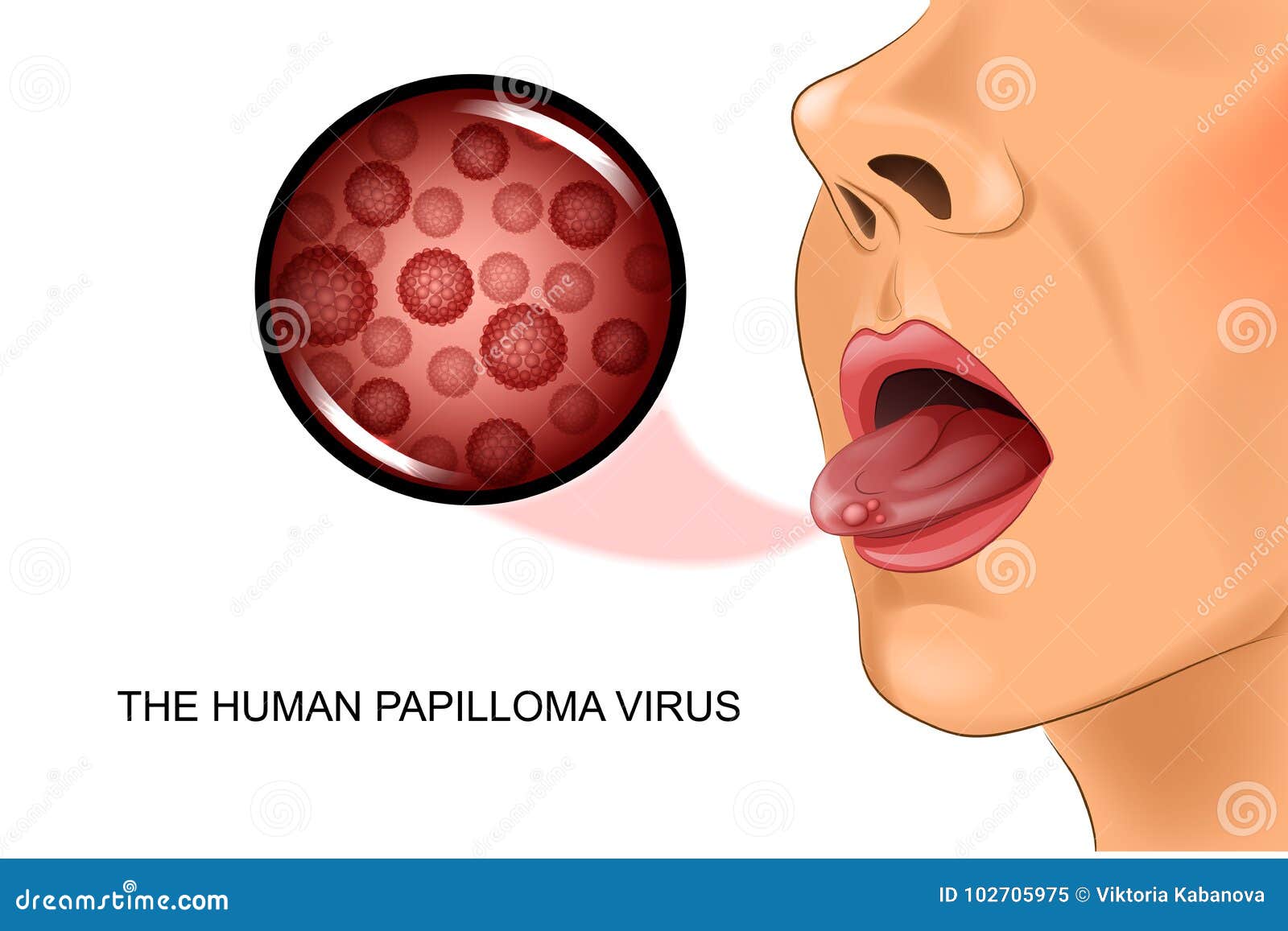 human papillomavirus on tongue)