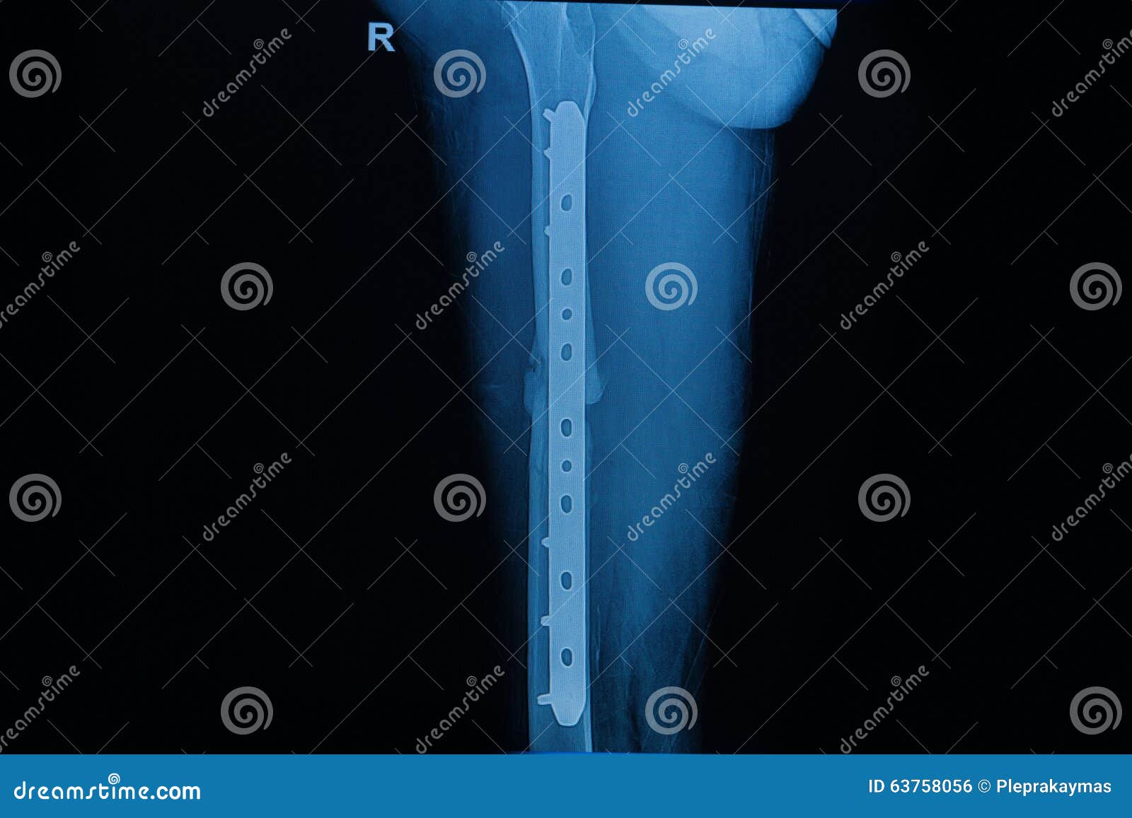 Human x-rays showing fracture of femur bone post operated. Human x-rays showing fracture of femur bone , post operated with internal fixed by plate and