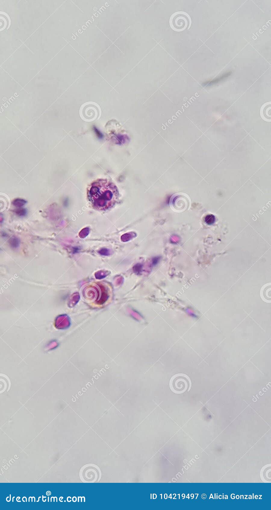 human semen sample show spermatozoon and white blood cell, posible semen infection