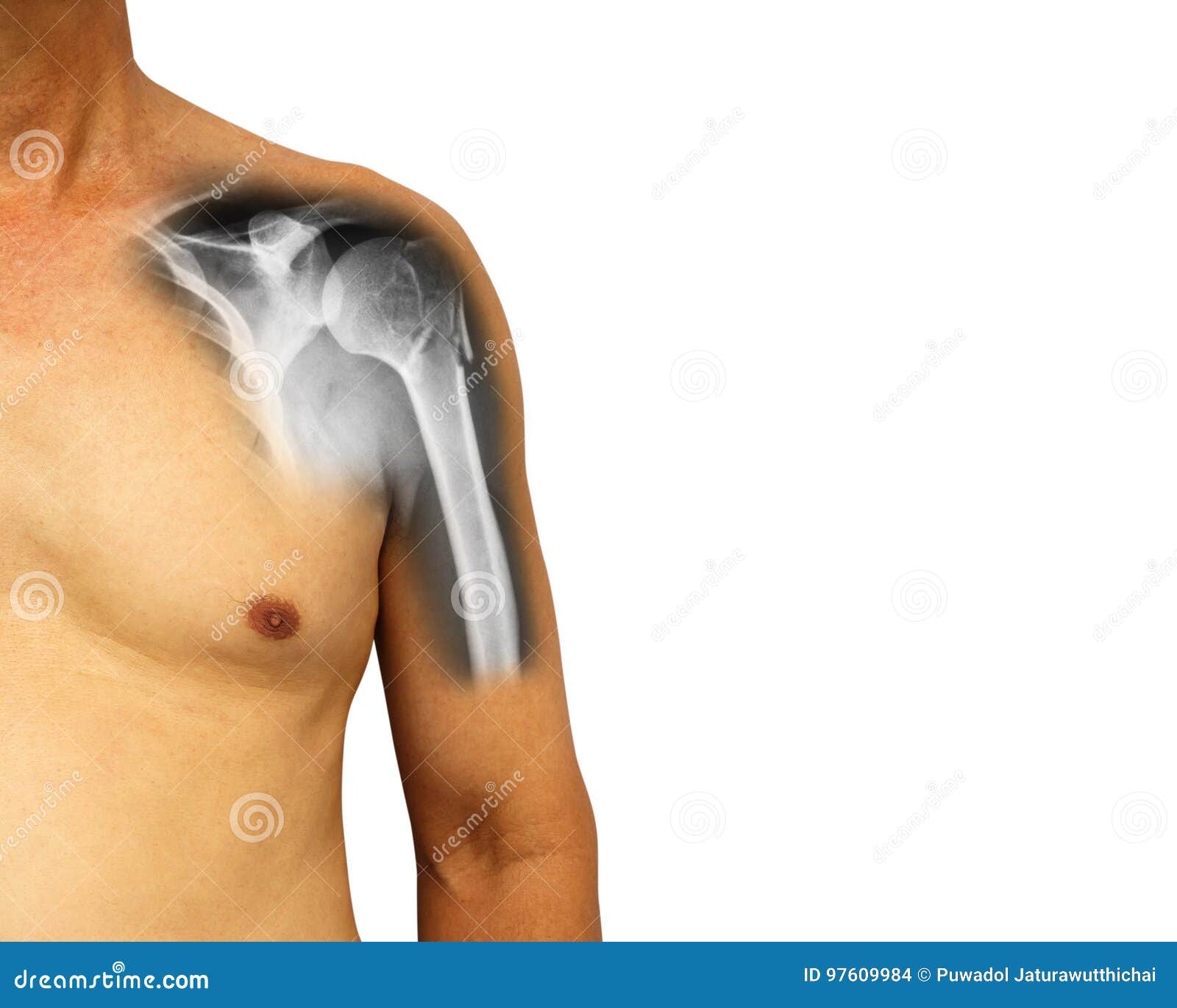 human shoulder with x-ray show fracture at neck of humerus arm bone .  background . blank area at right side