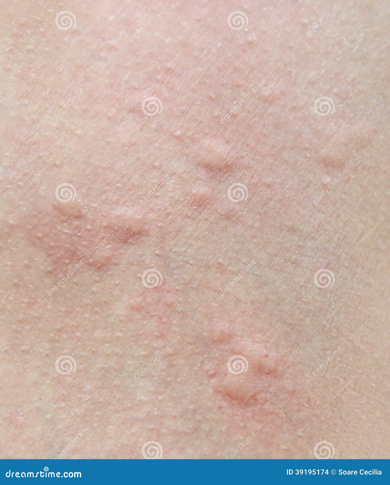 Human Skin Presenting An Allergic Reaction Stock Photo Image Of