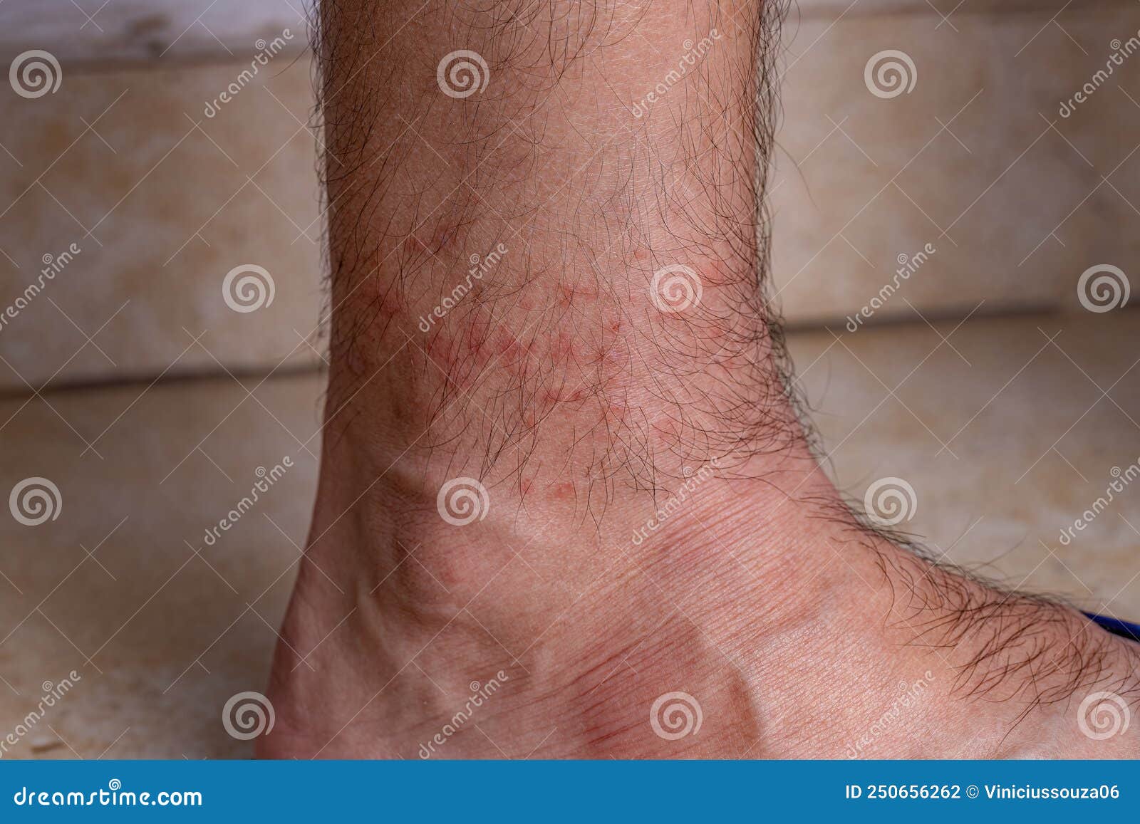 Allergic Reactions To Tick Bites Stock Photo Image Of Blood Ixodes