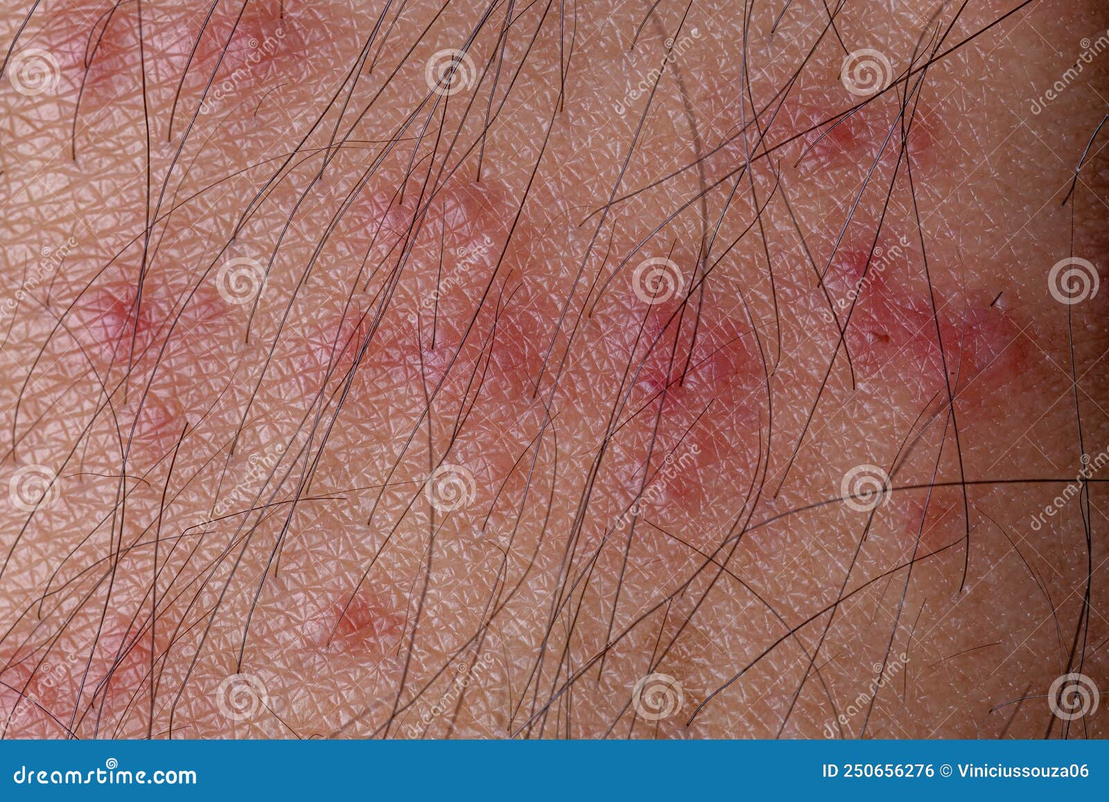 Allergic Reactions To Tick Bites Stock Photo Image Of Animal Allergy