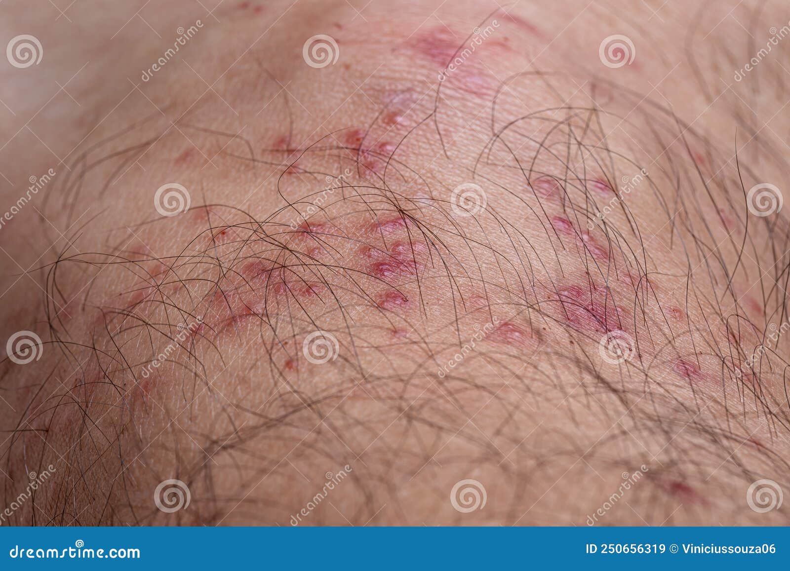 Allergic Reactions To Tick Bites Stock Image Image Of Hardbacked