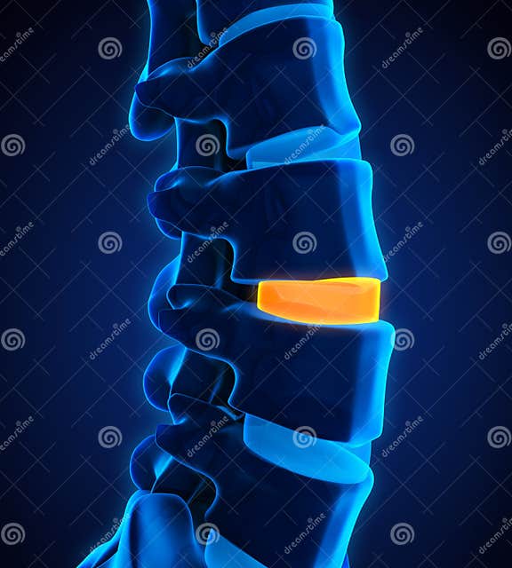 Human Spine Disc Degenerative Stock Illustration - Illustration of ...