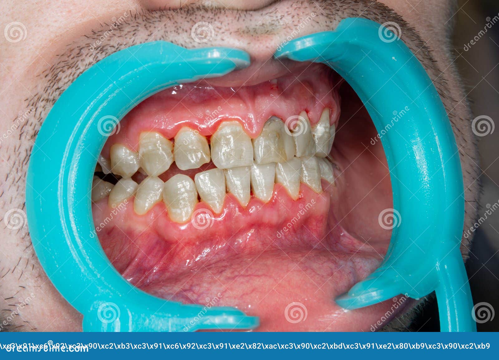 human teeth closeup with dental plaque and inflammation of gingivitis. concept of brushing teeth and poor hygiene
