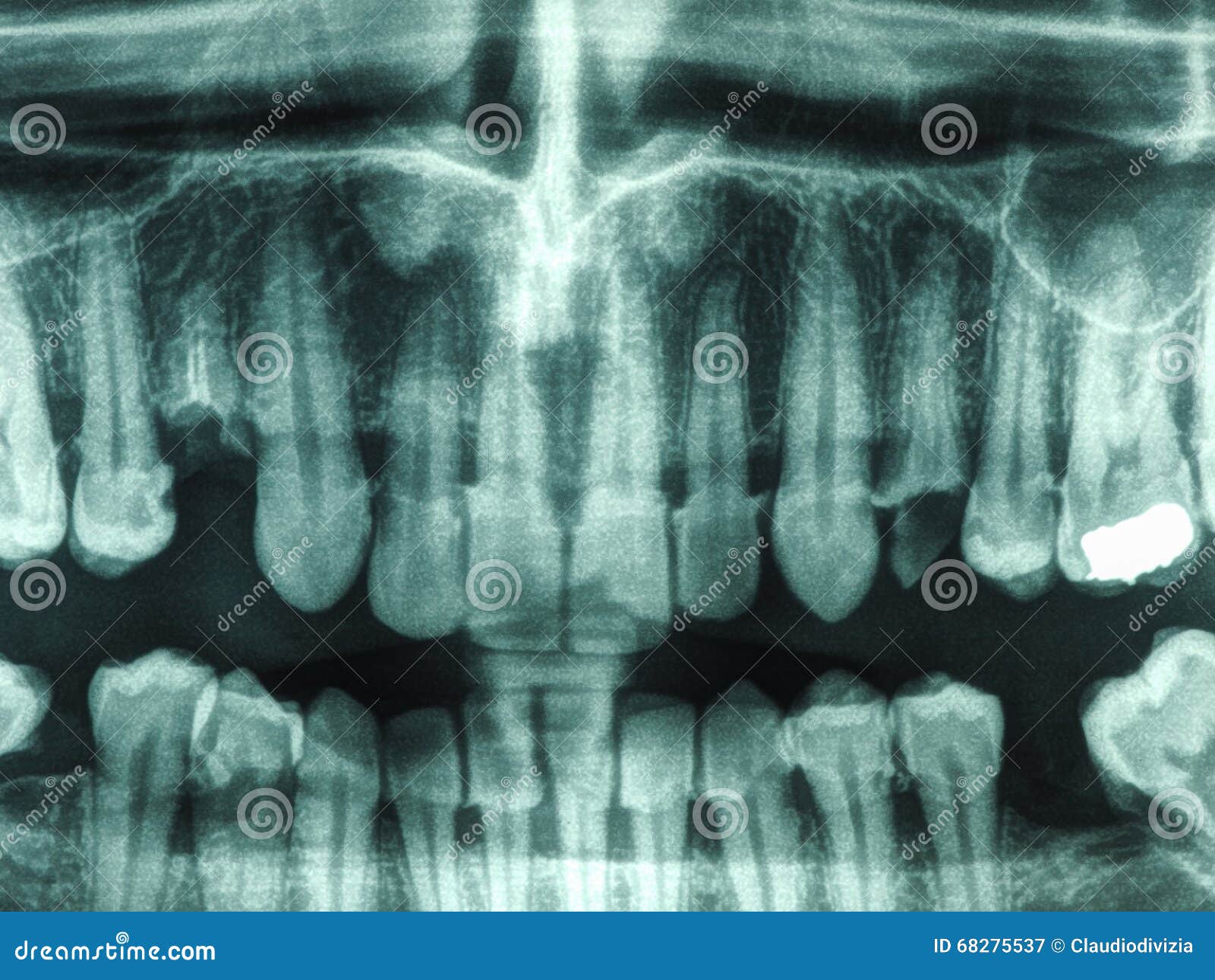 Human teeth xray stock image. Image of bones, care, dentist 68275537