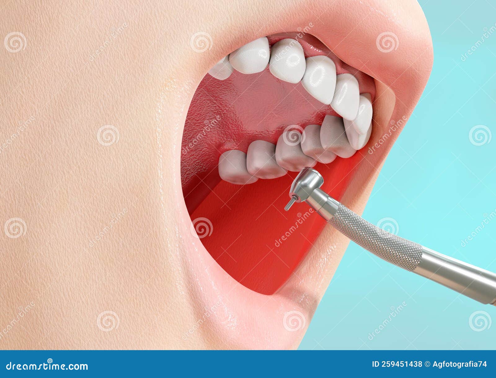 Human Tooth Caries Removal Process with Drill Machine Stock