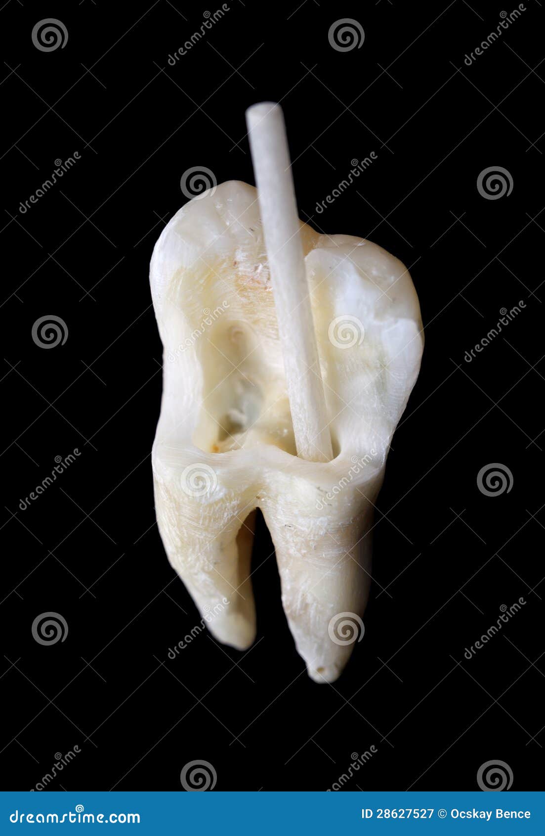Human Tooth With Fiber Resin Post Royalty Free Stock Photography