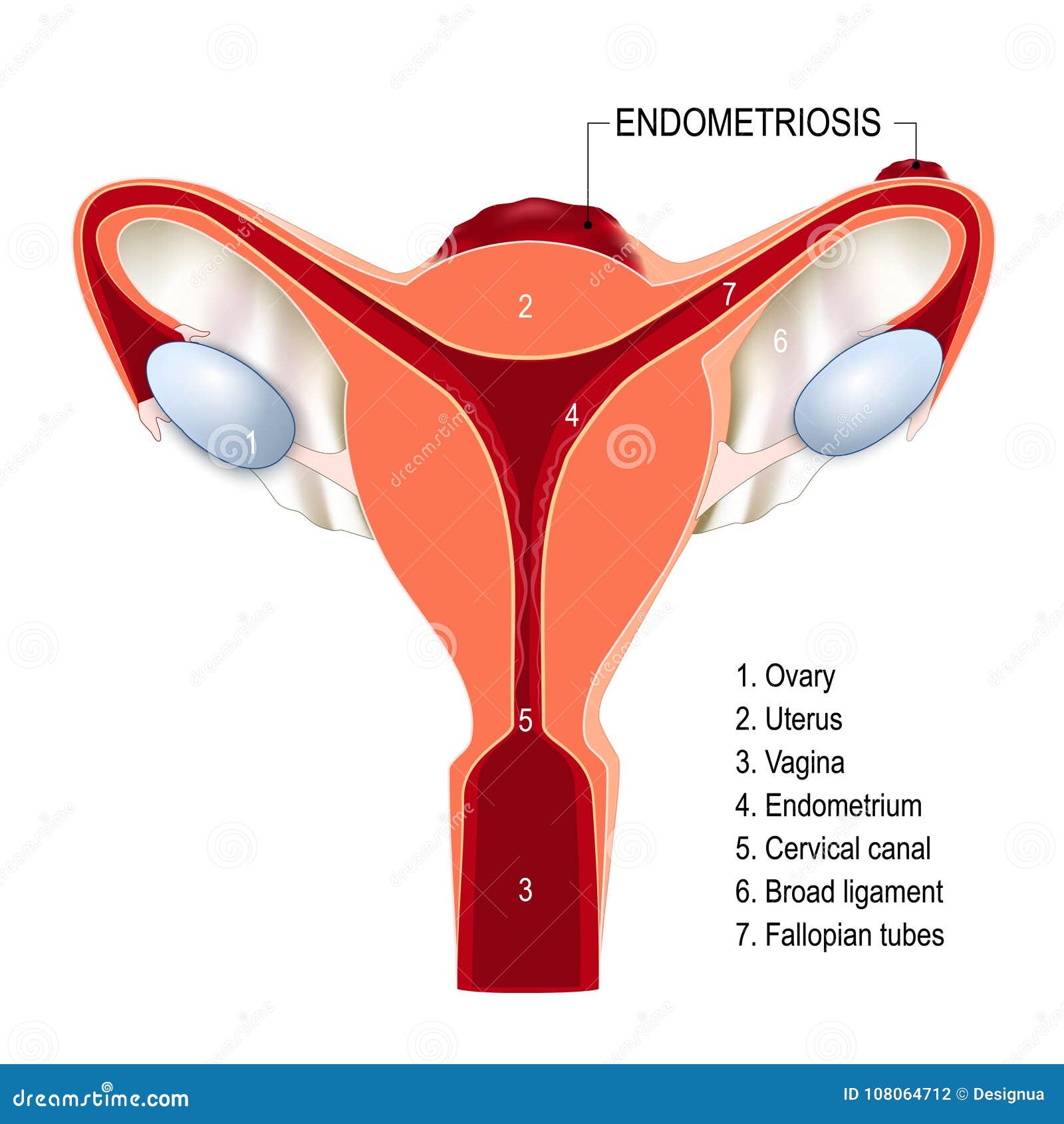 human papillomavirus infection endometriosis