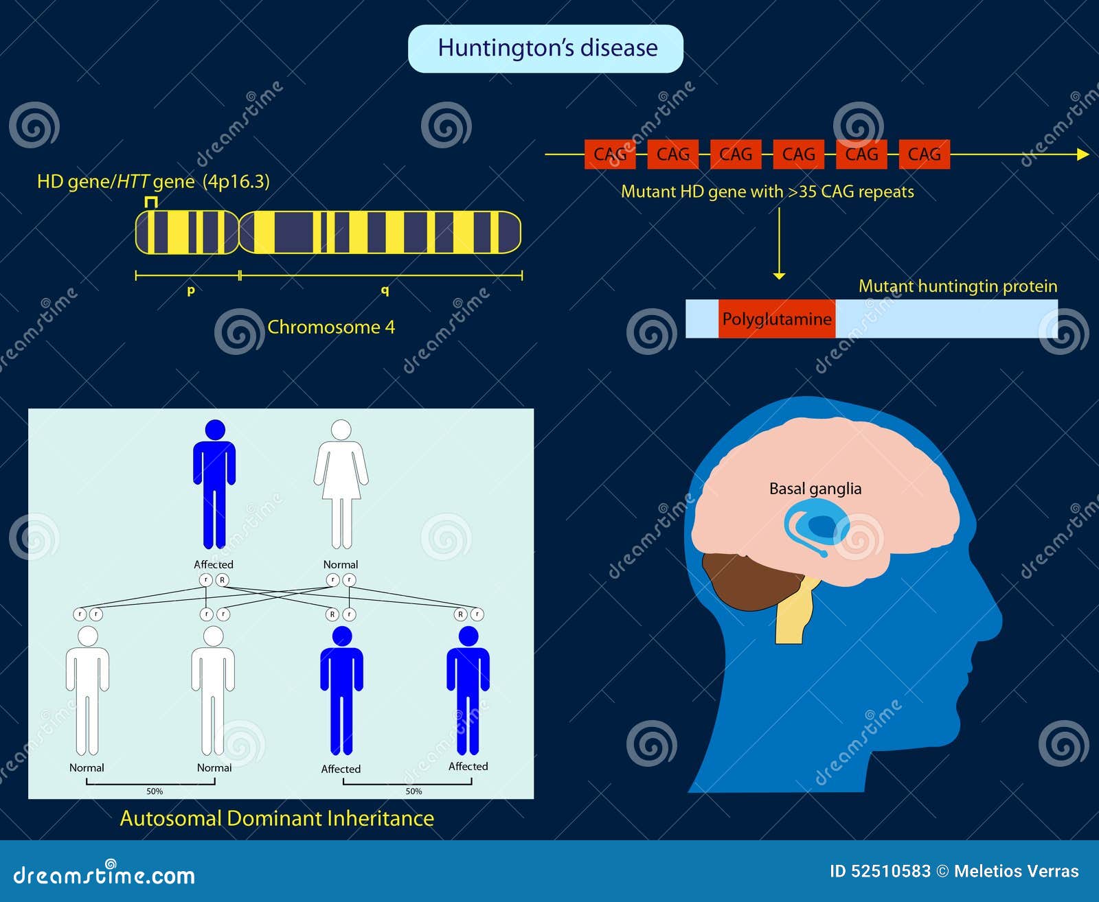 Huntington's Disease Stock Illustration Image 52510583