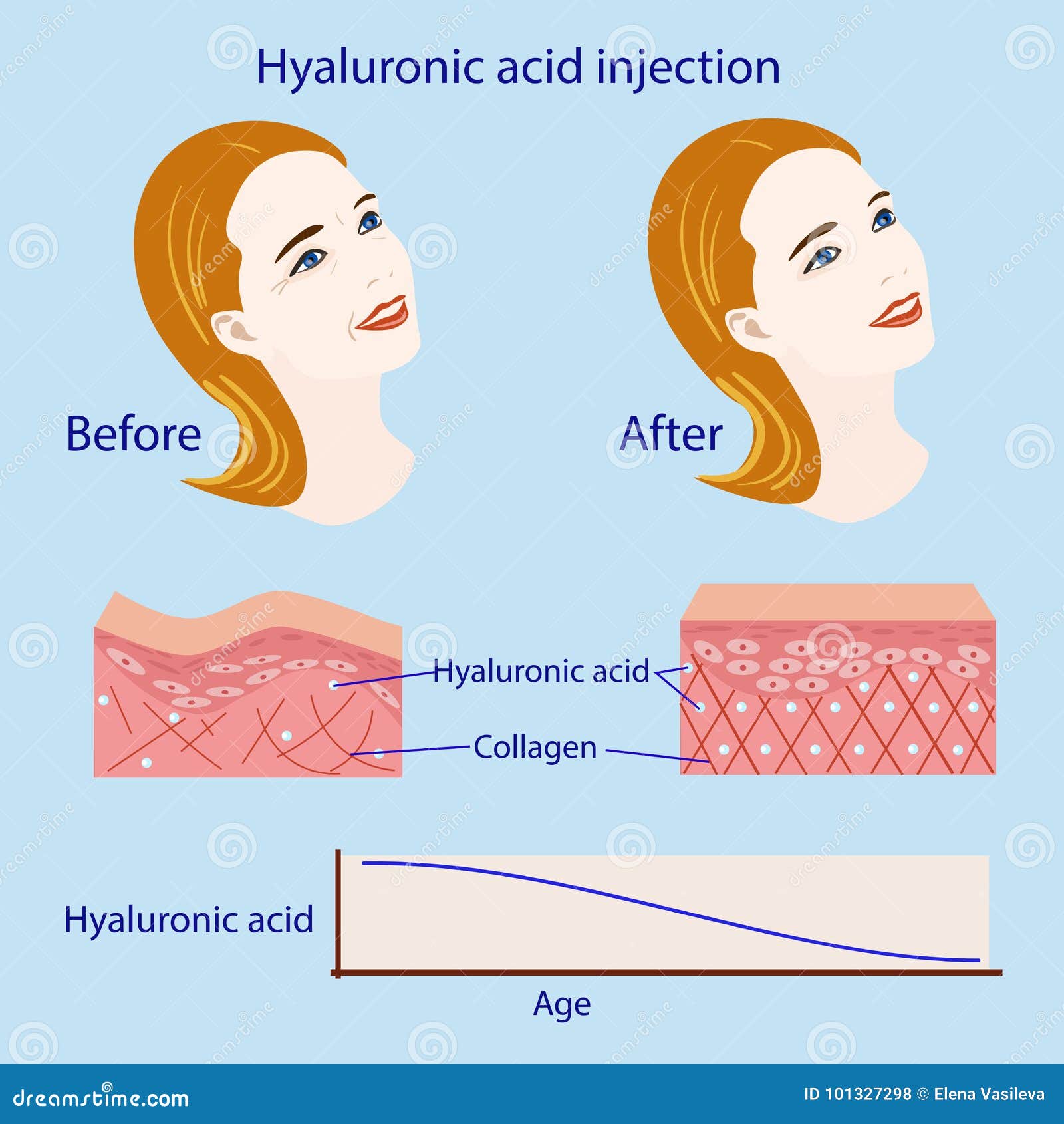 injectare acid hialuronic