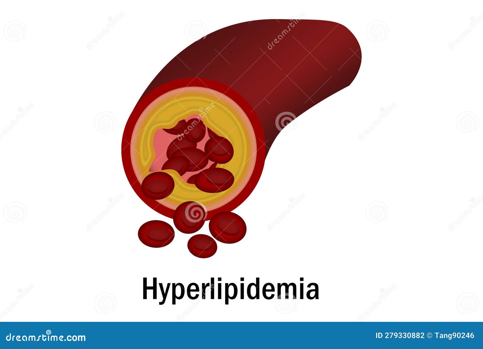 hyperlipidemia with blood vessel 