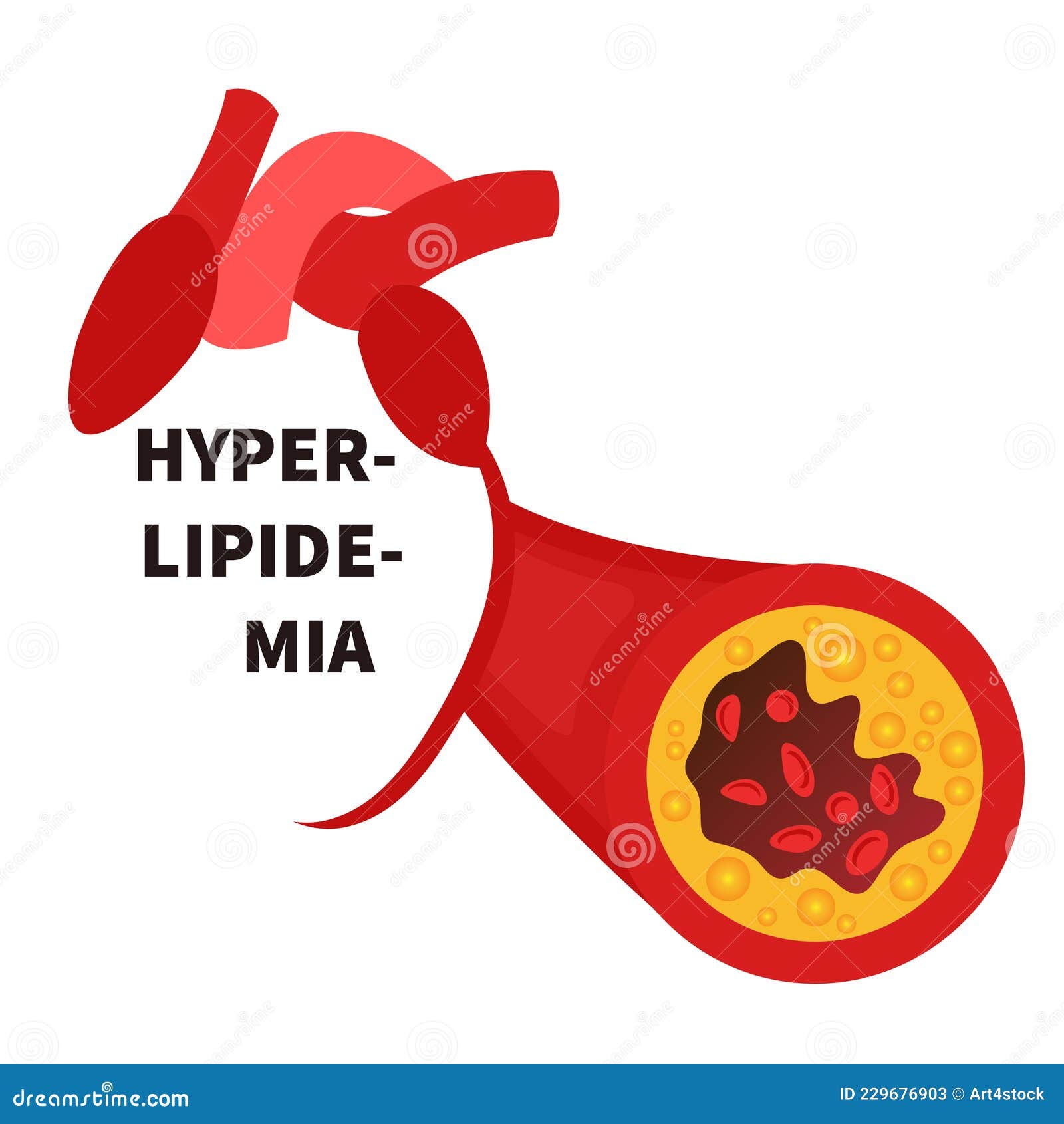 hyperlipidemia conceptual  of blocked blood artery vessel