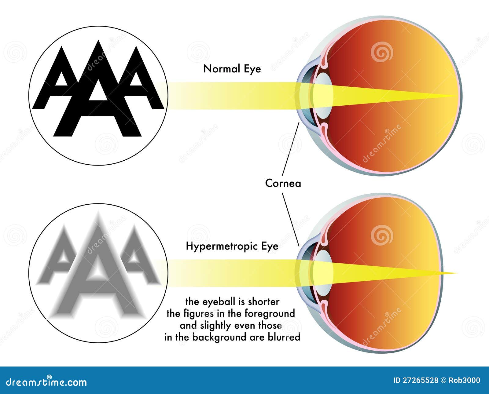 What are the symptoms of Hypermetropia?