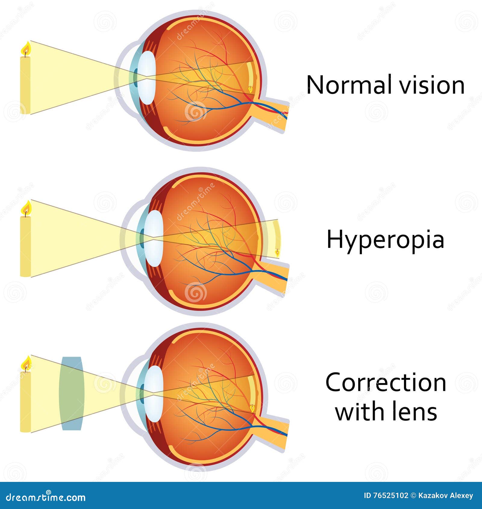 Hyperopia Corrected By A Plus Lens Stock Vector Illustration Of Anatomy Farsighted Hyperopia Corrected By A Plus Lens Stock Vector Illustration Of Anatomy Farsighted