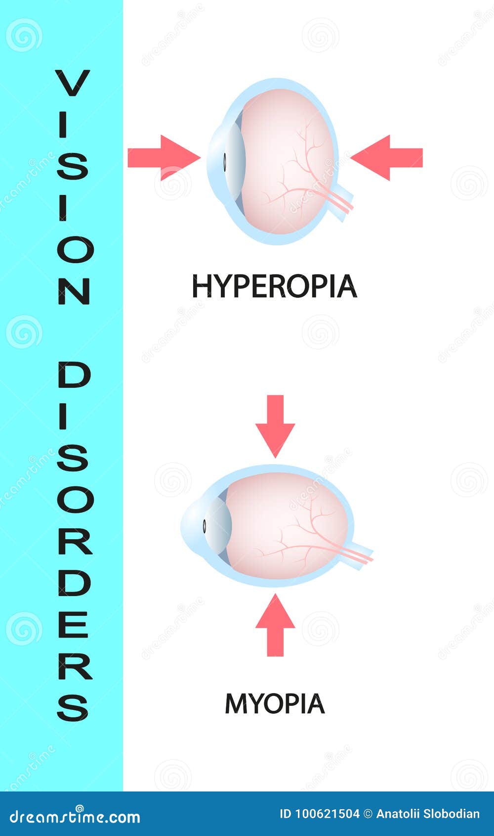 Távollátás (hypermetropia) Hyperopia plus