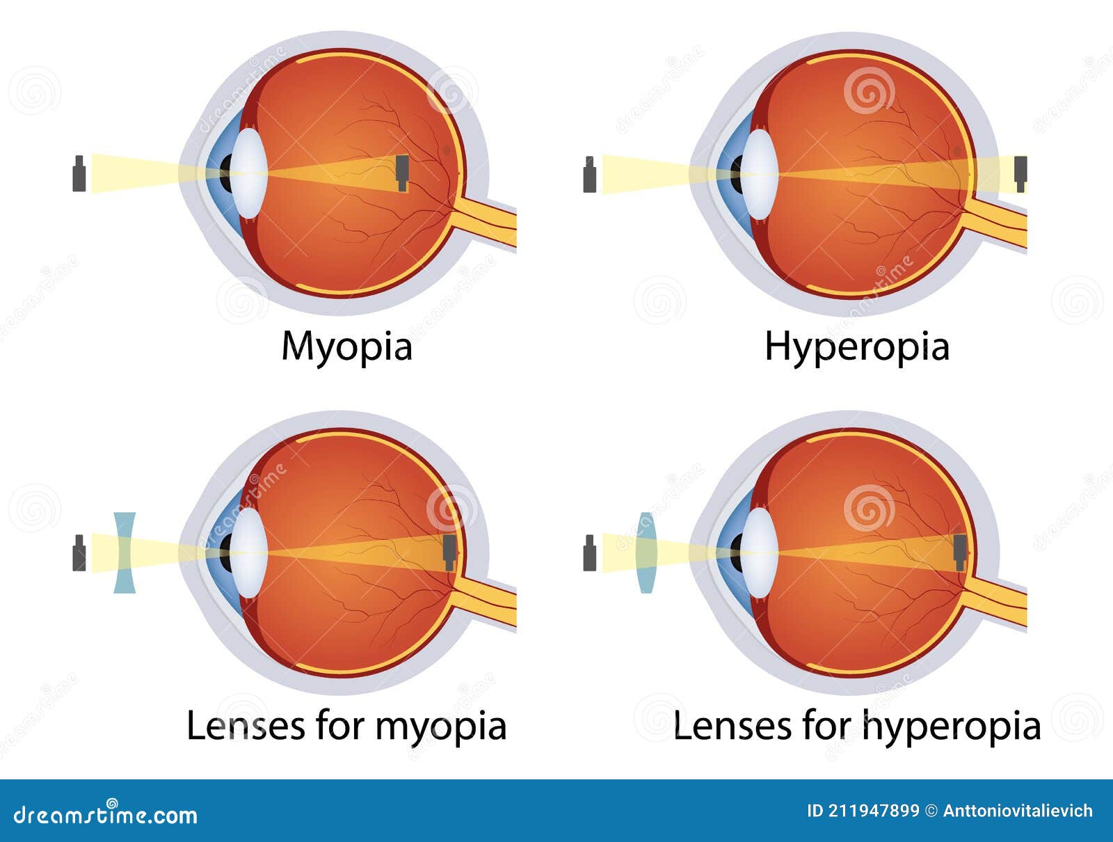 myopia hyperopia norma)