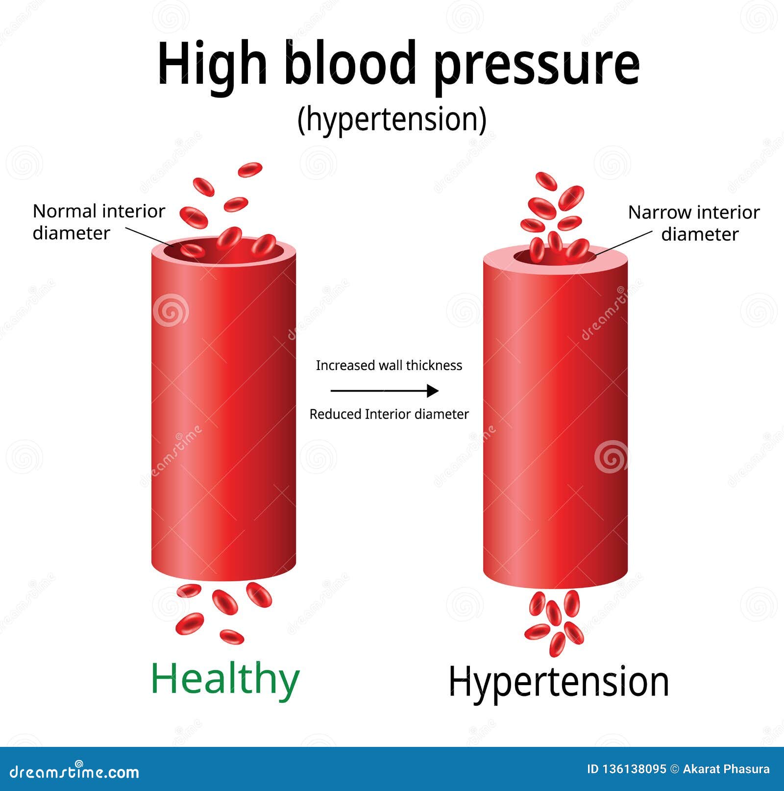 hypertension, high blood pressure ,