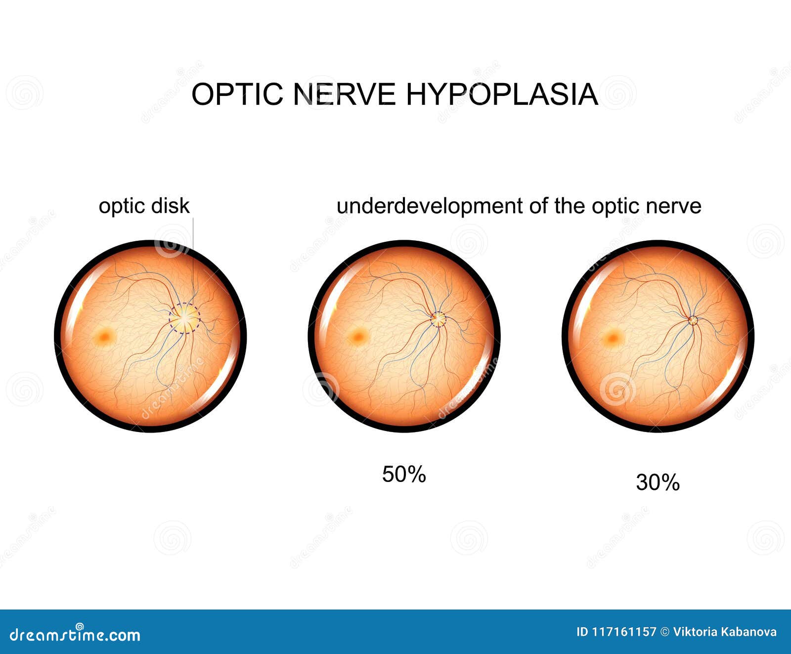 Optic Nerve Structure. Bundle Of Nerve Fibers That Transmit Visual ...