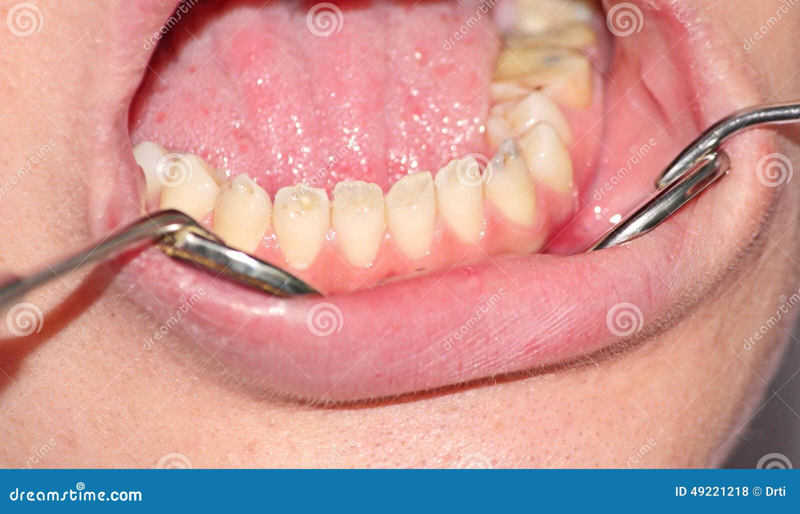 hypoplasia of tooth enamel