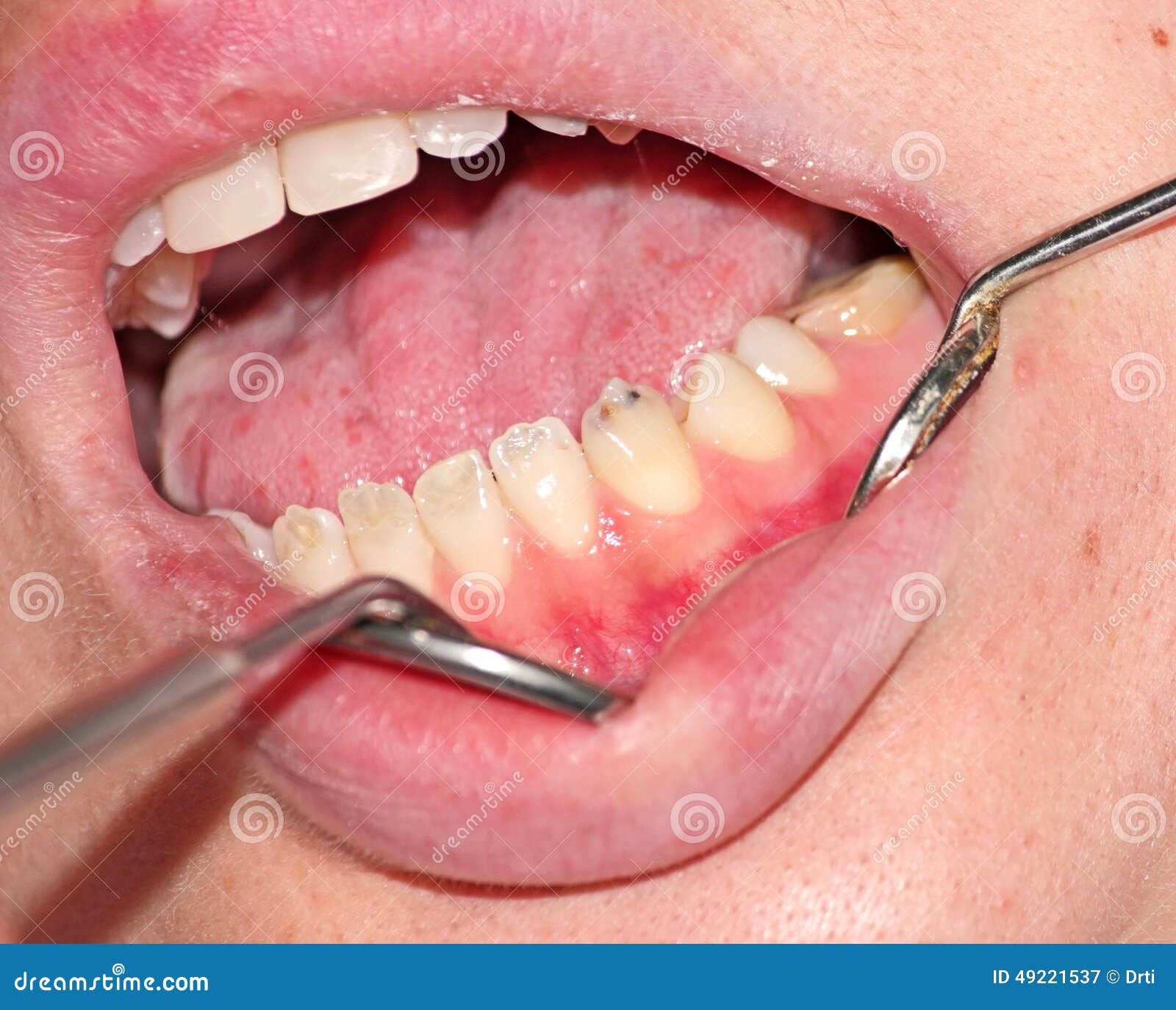 Hypoplasia of tooth enamel stock image. Image of illness 49221537