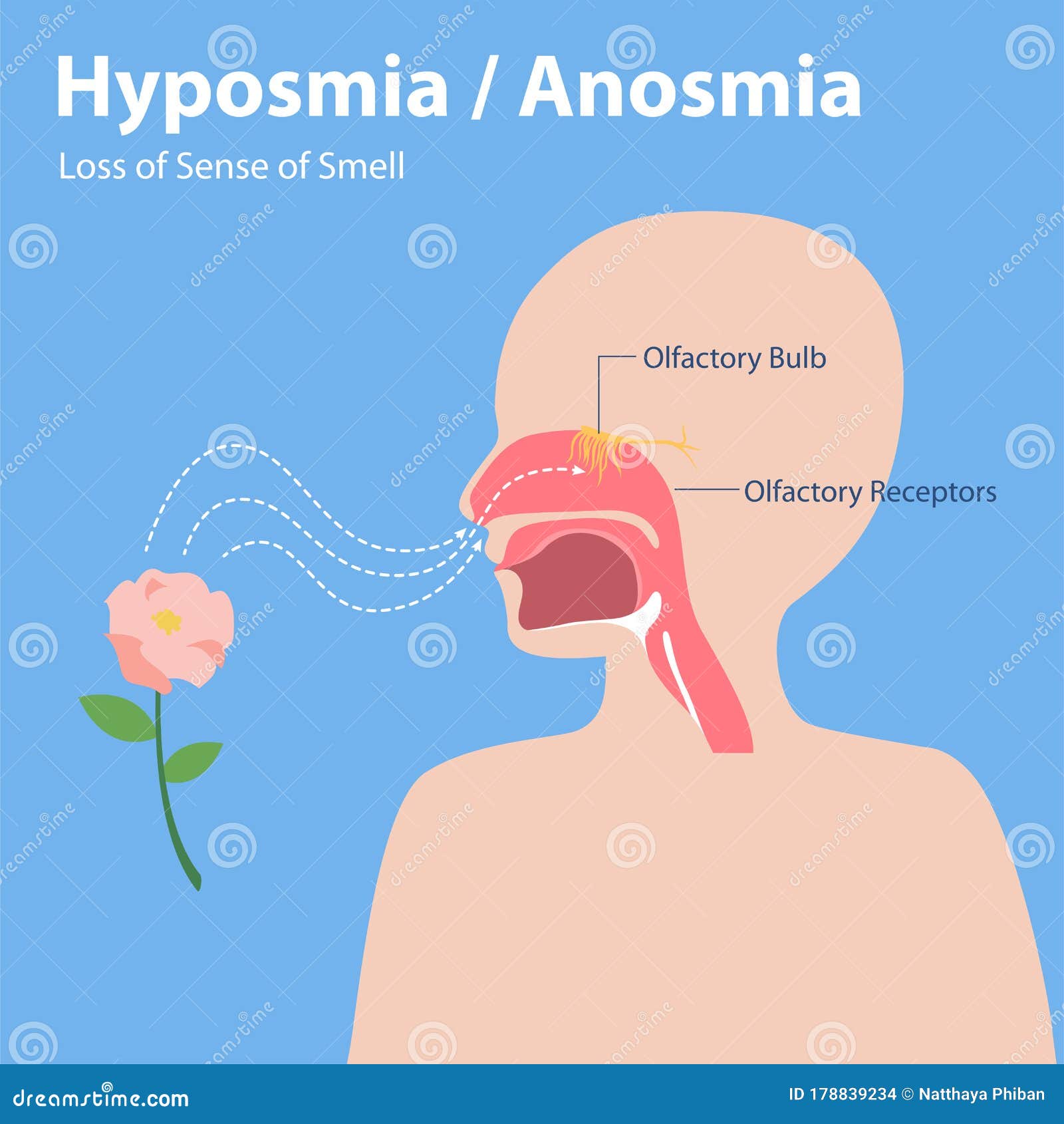 hyposmia anosmia, loss of sense of smell