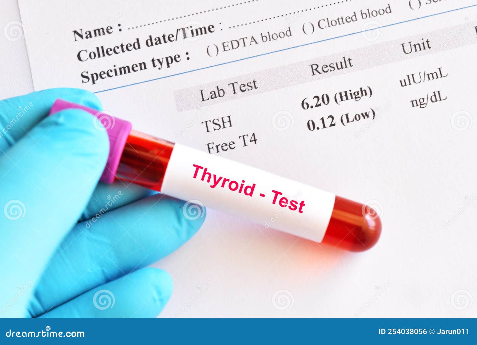 Hypothyroidism Result With Blood Sample Royalty Free Stock Photography hypothyroidism-result-with-blood-sample-royalty-free-stock-photography