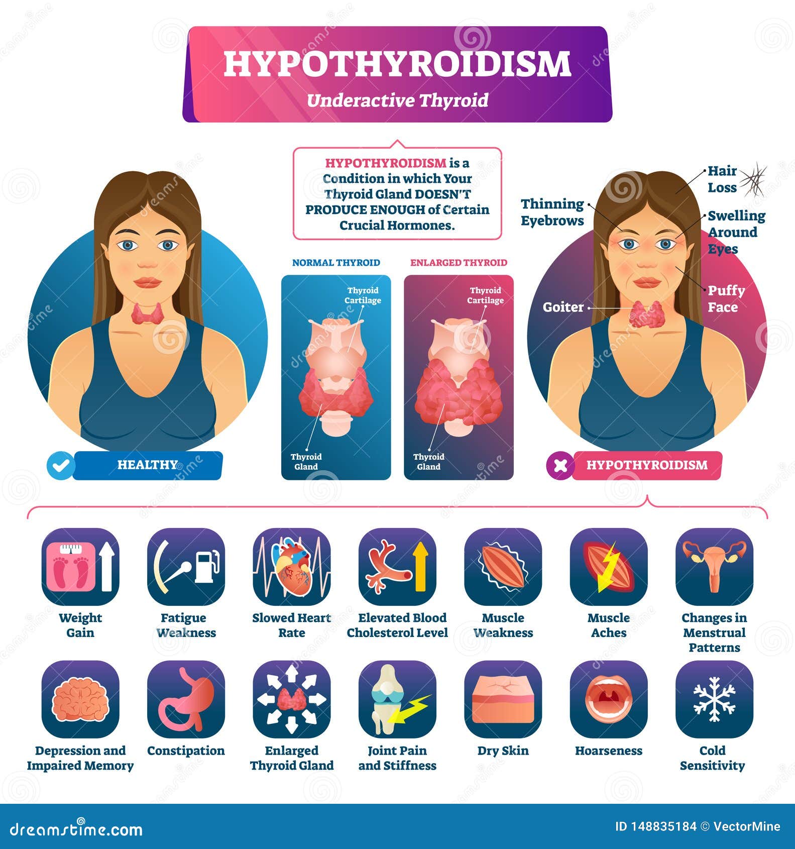 hypothyroidism  . labeled underactive thyroid explanation