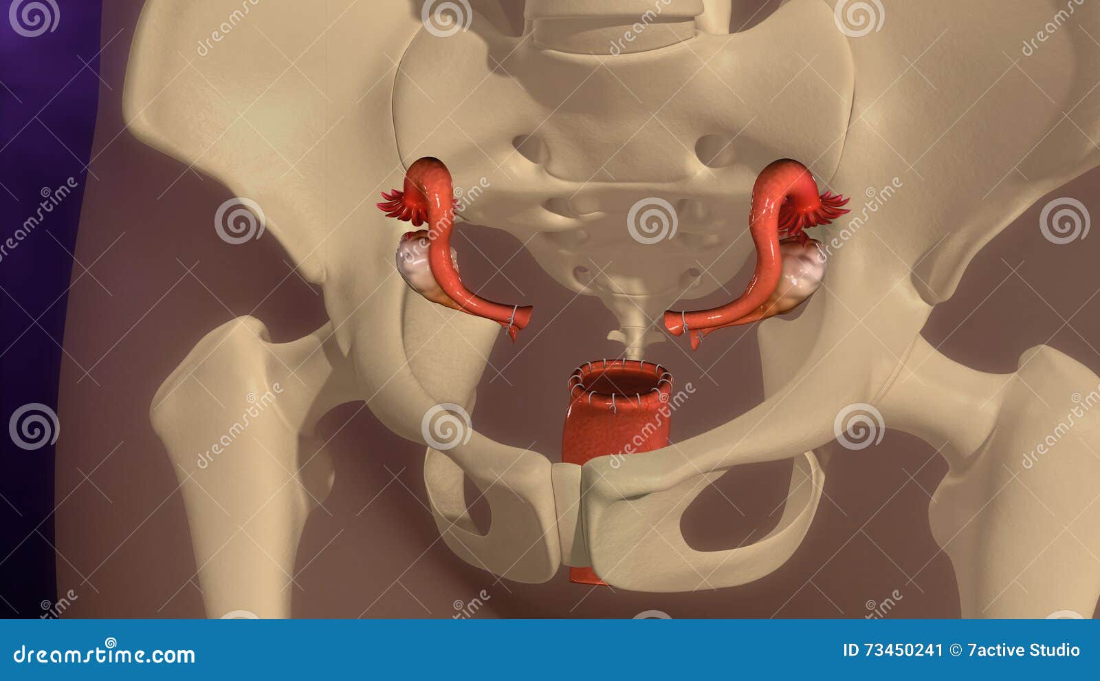 Hysterectomie stock illustratie. Illustratie bestaande uit bekken