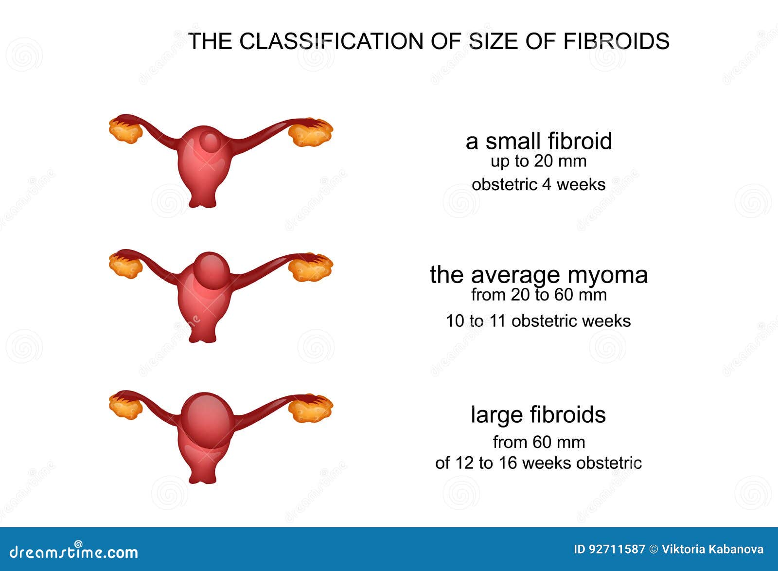 hysteromyoma uterine myoma vector illustration fibroids week pregnancy 92711587