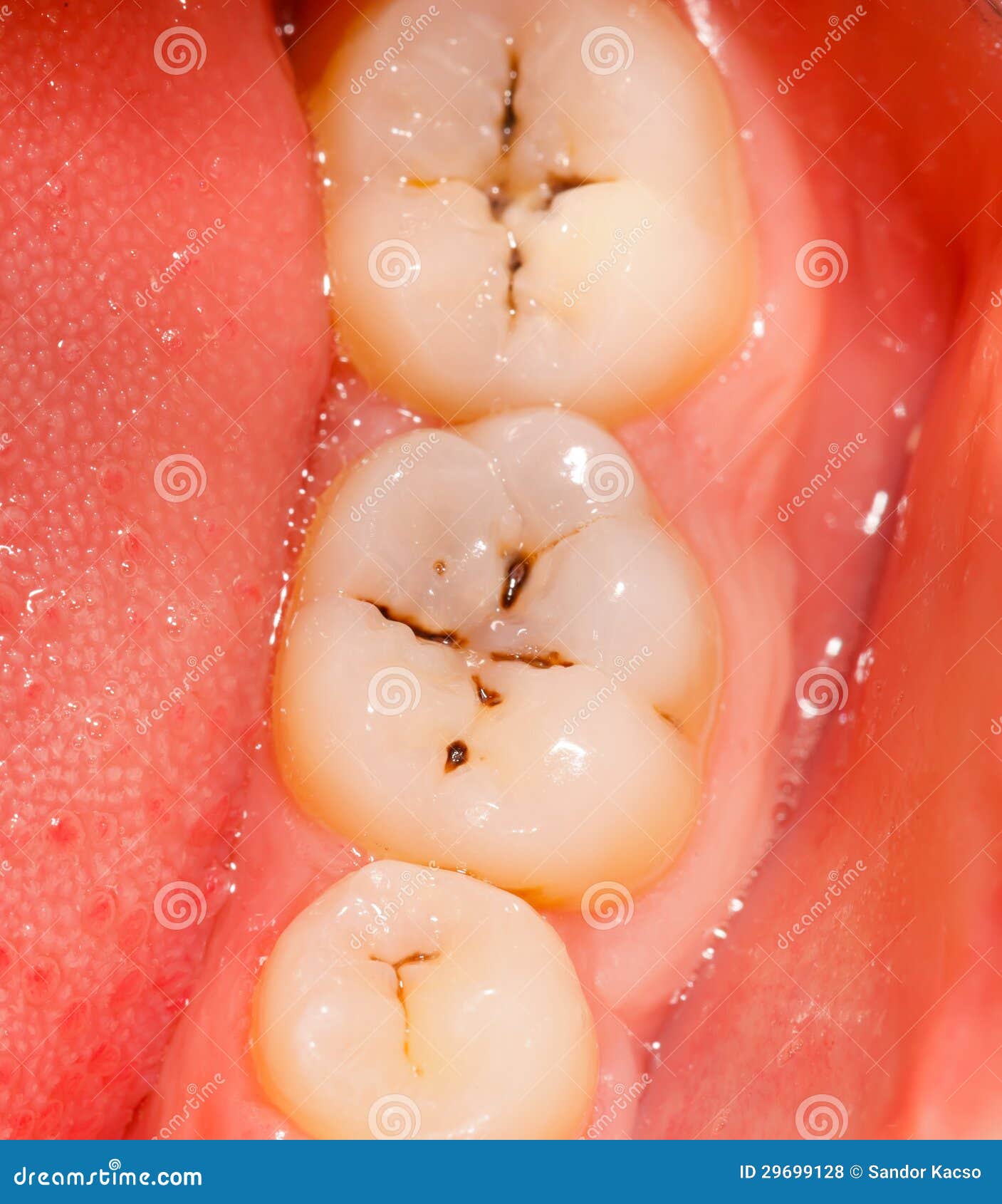hål i tand