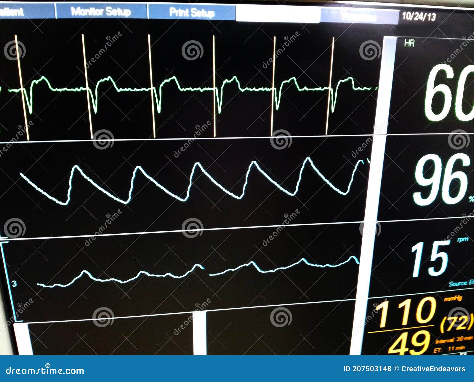 icu monitor screen showing pacemaker spikes on top tracing