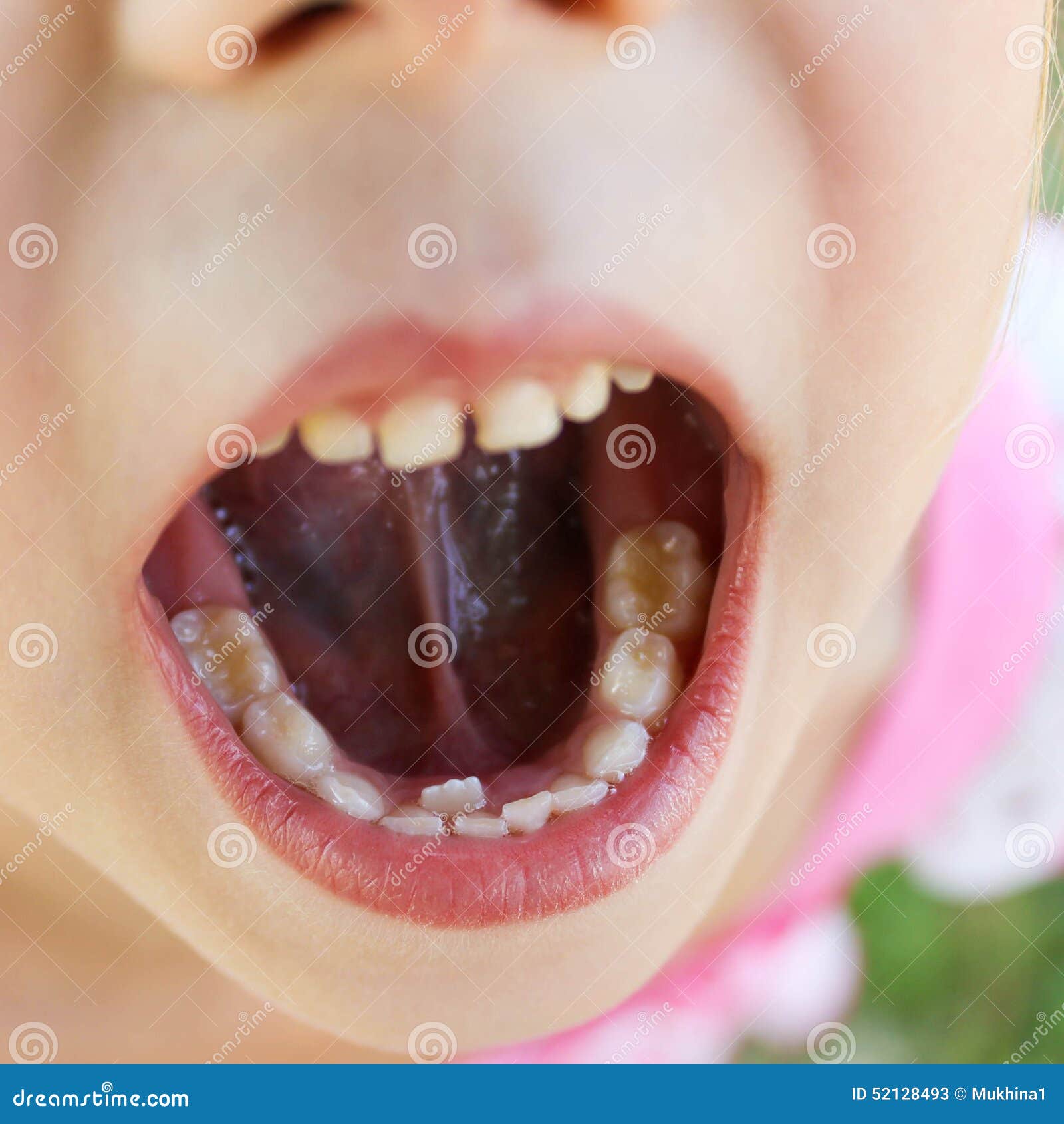 Radice Dente Da Latte Nella Gengiva Il Dente Da Latte Ancora Non è Caduto, Il Seguente Ha Coltivato Il