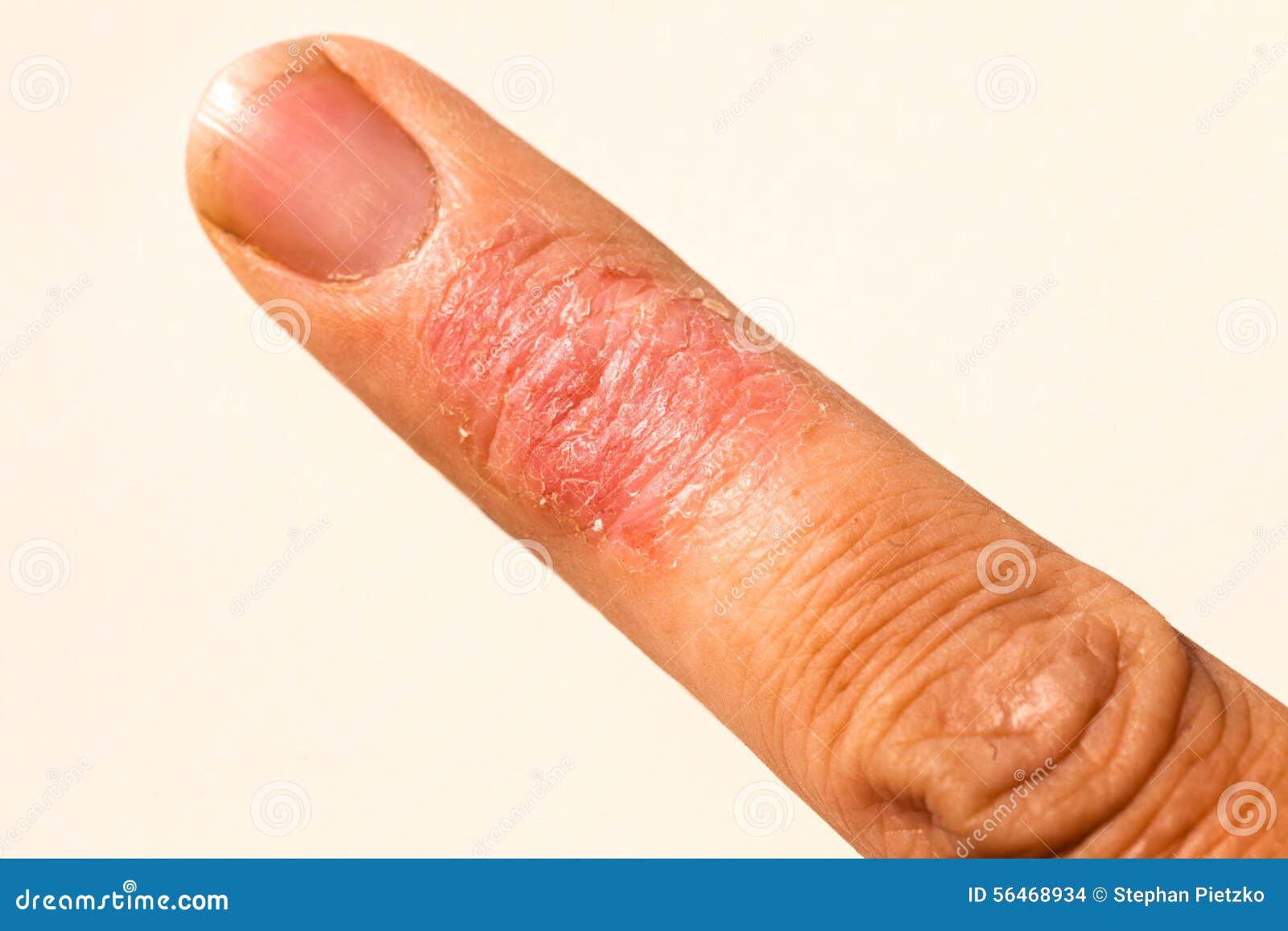 Dermatitis and Finger itch - Symptom Checker - check ...