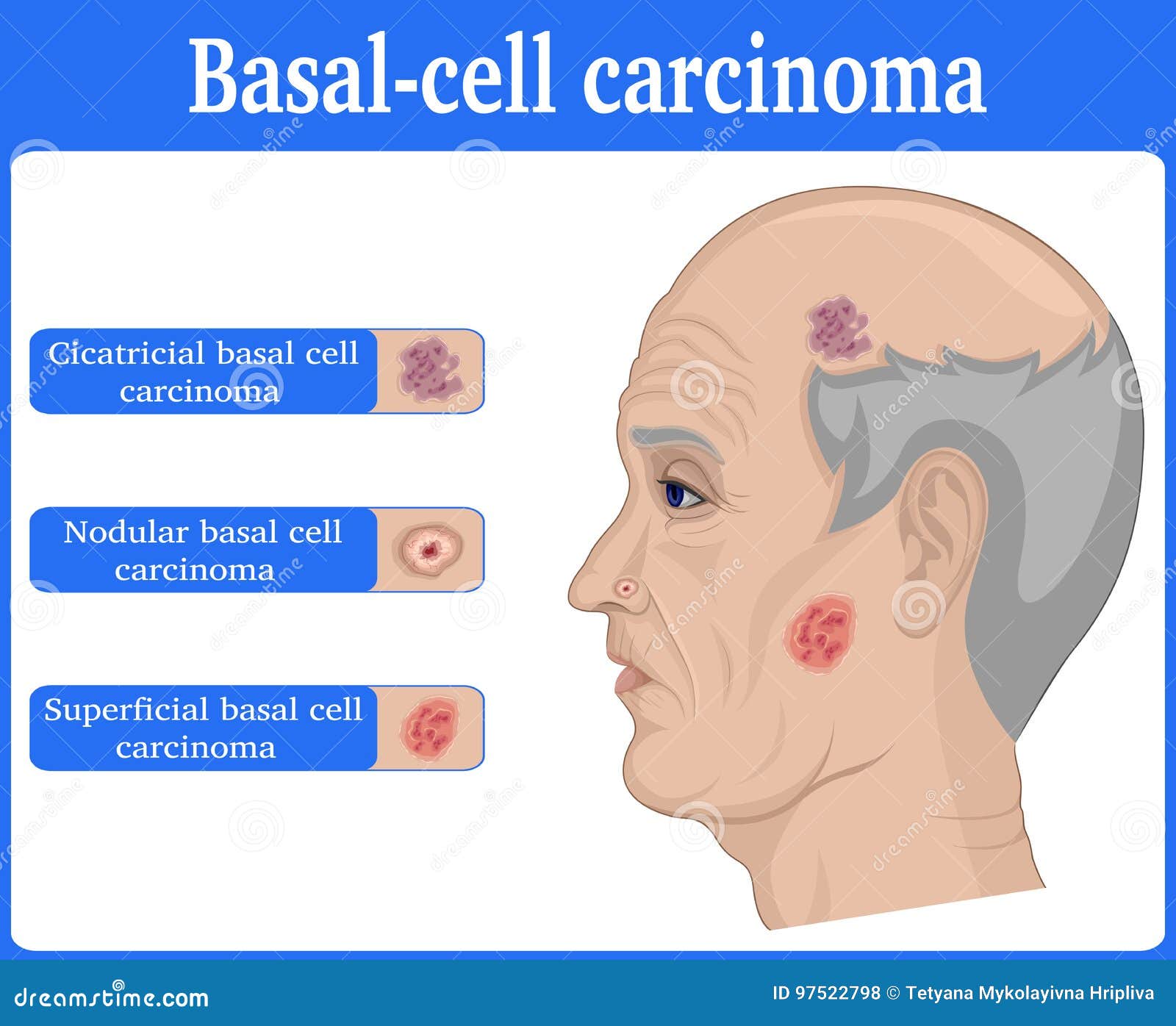  of basal cell carcinoma