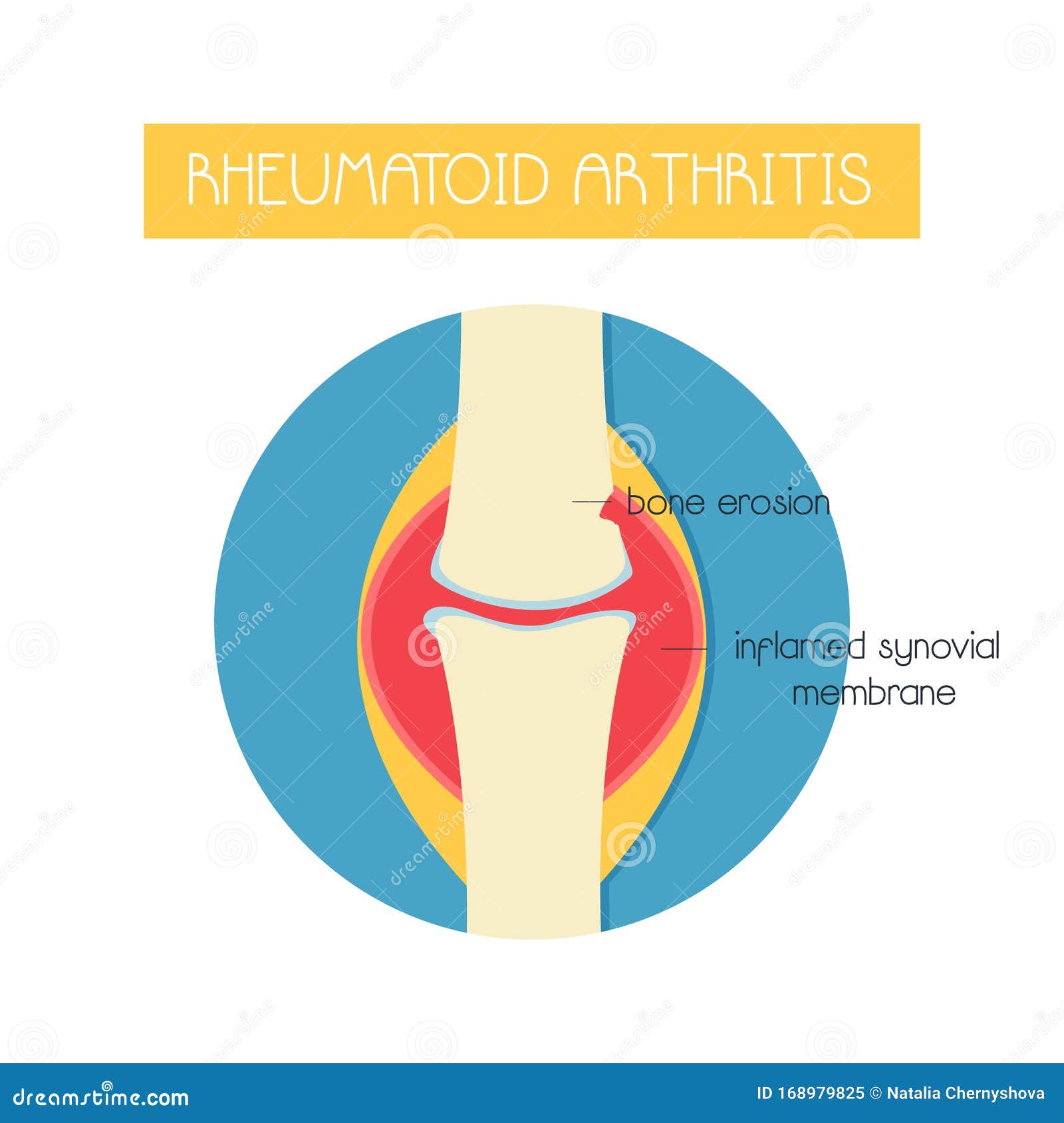reumatoid artritisz sport heparin kenőcs az ízületek kezelésében