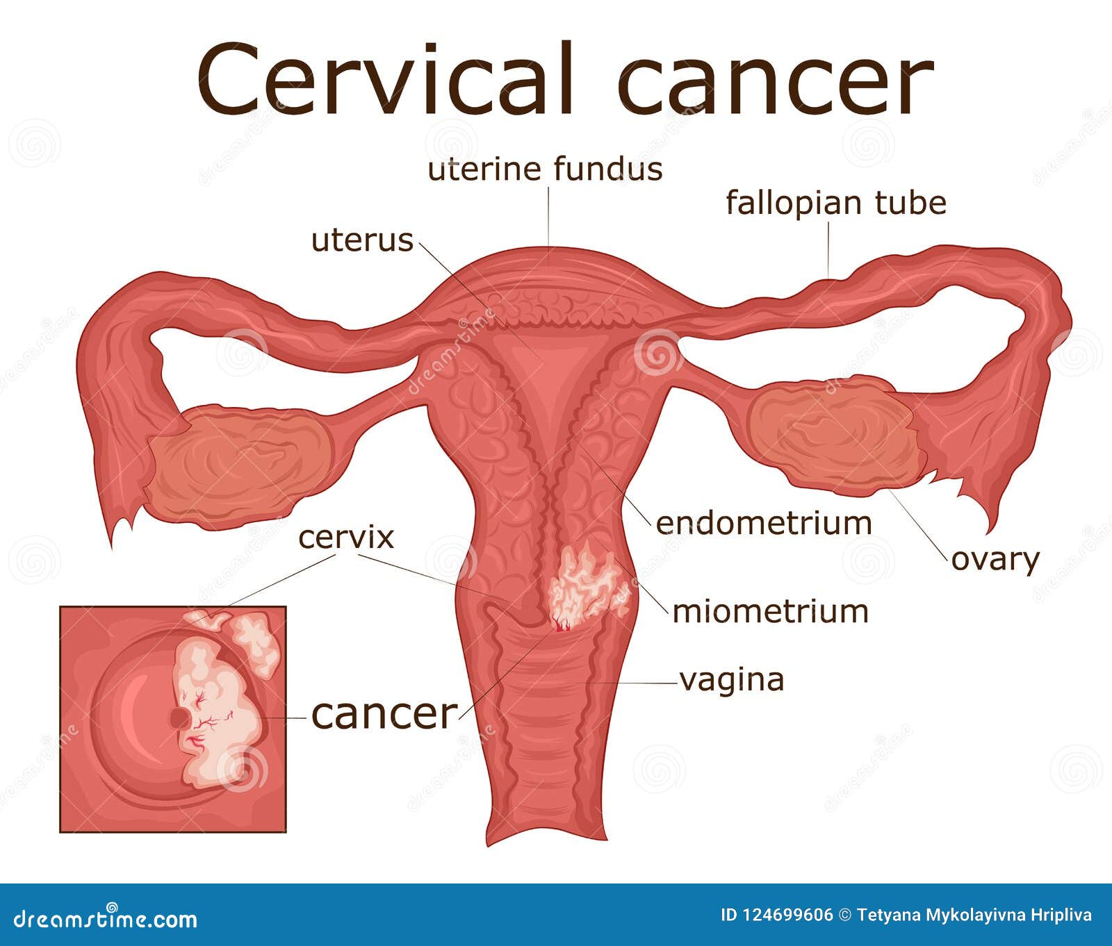  of cervical cancer