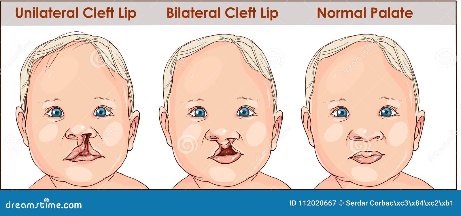 Illustration Of A Cleft Palate In A Child. Plastic Surgery