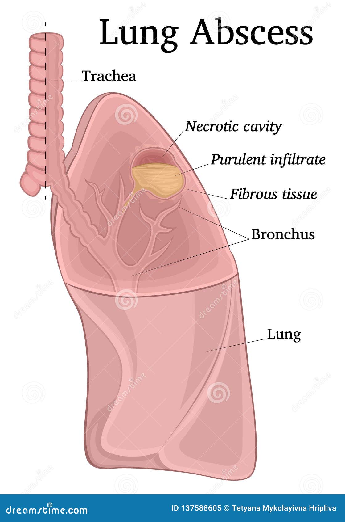 Illustration D'abcès De Poumon Illustration de Vecteur ...
