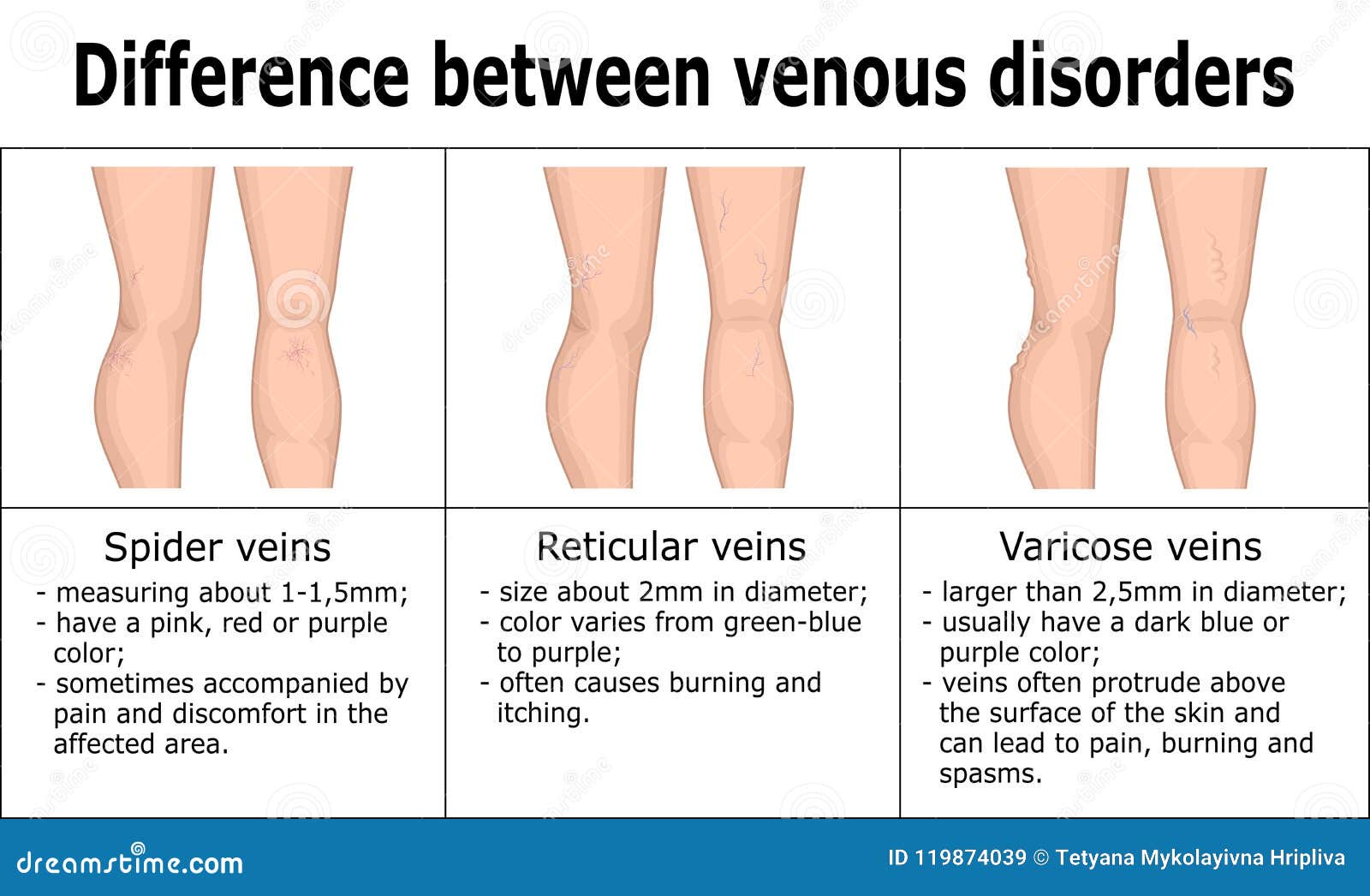 simptomele varicoase reticulare