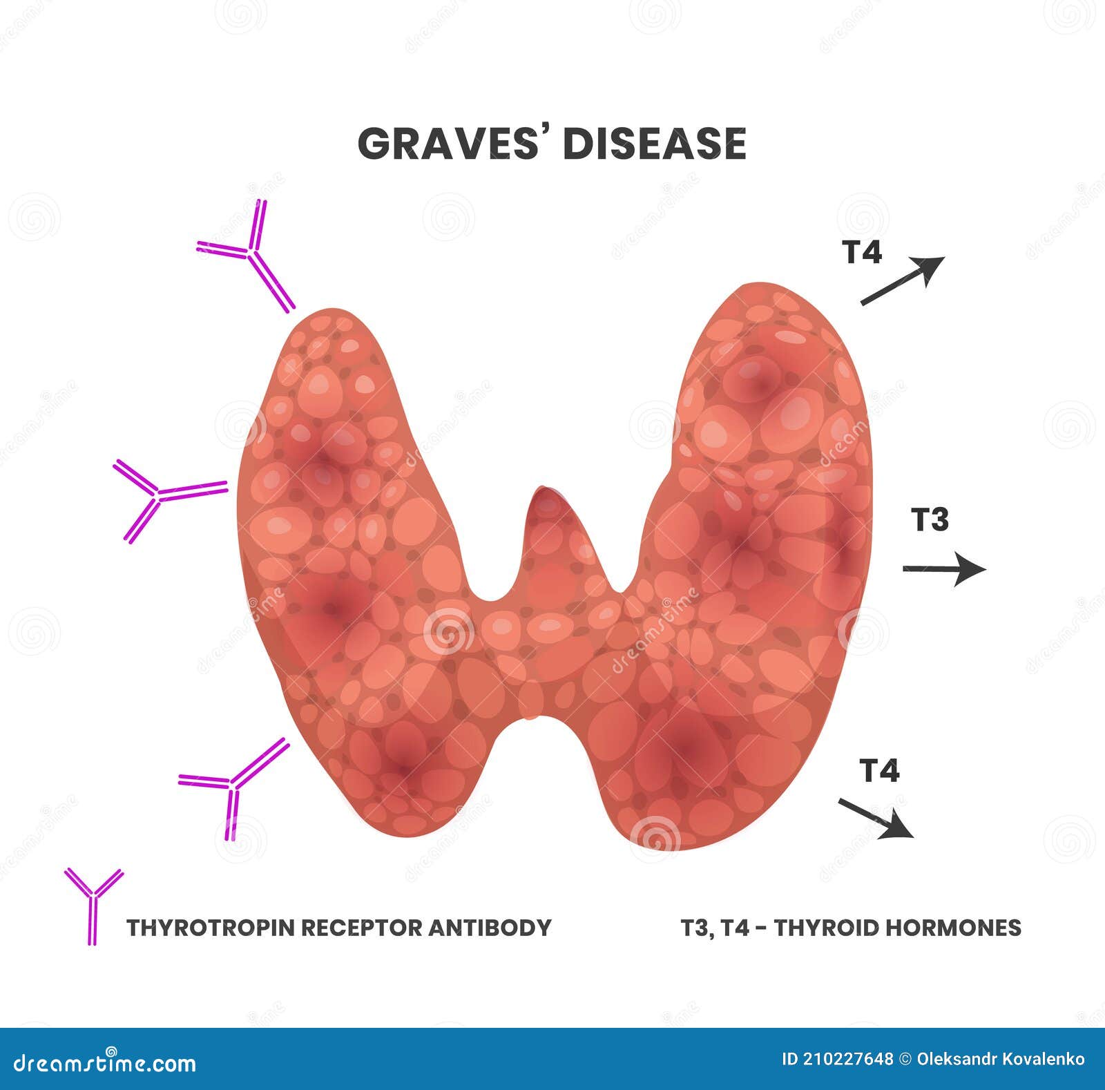 Illustration of the Graves Disease Causes. Vector Scheme Showing
