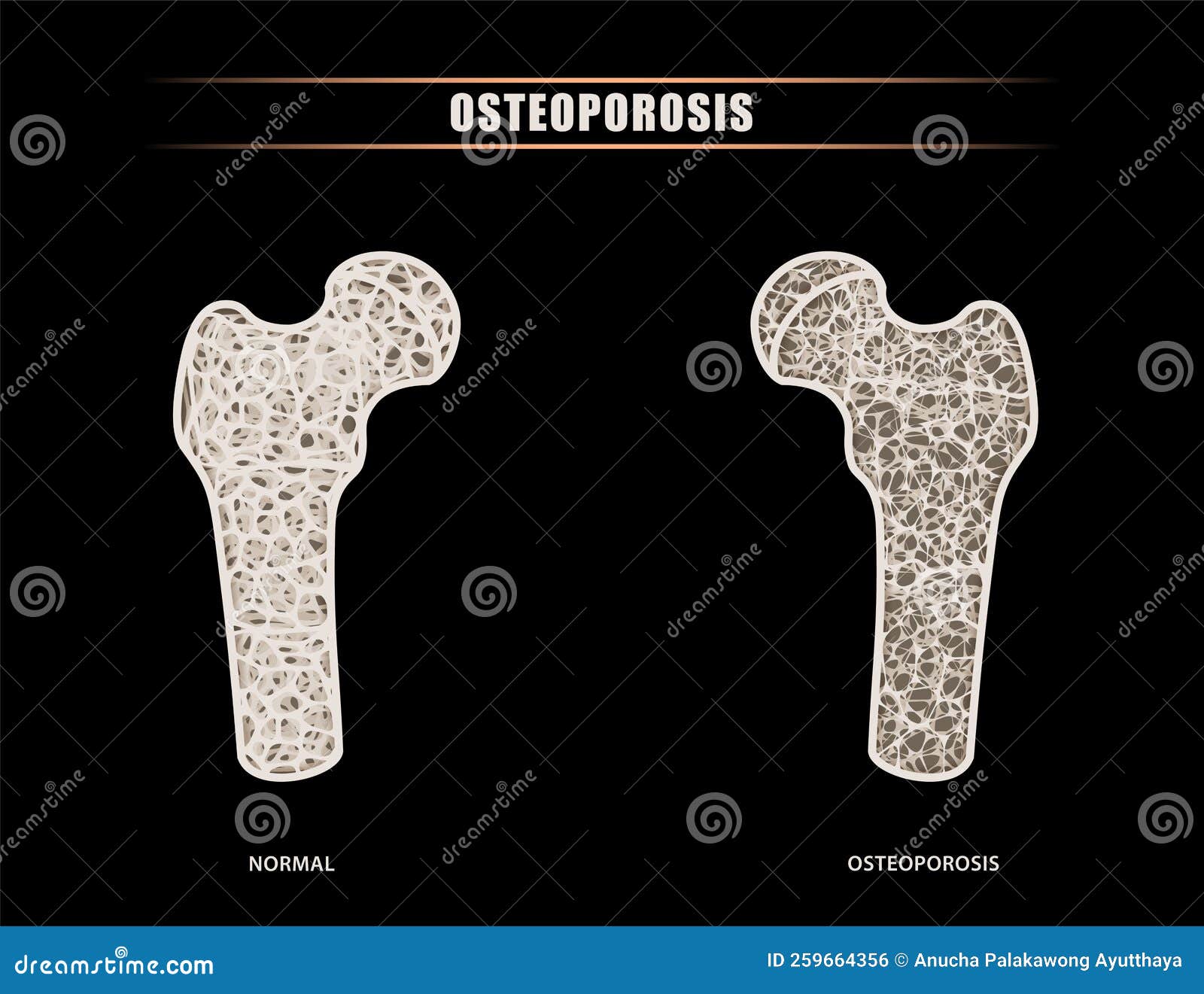 Illustration Of A Human Femur Versus Hip Intra Articular Comparison Of