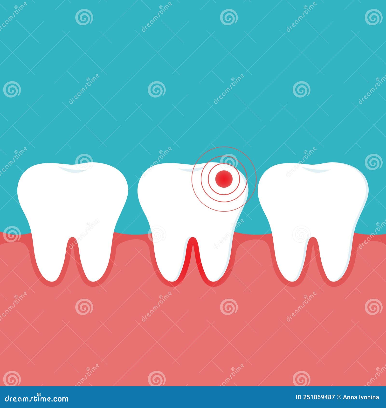 Illustration Of An Inflamed Tooth And Gum And Healthy Teeth Gingivitis