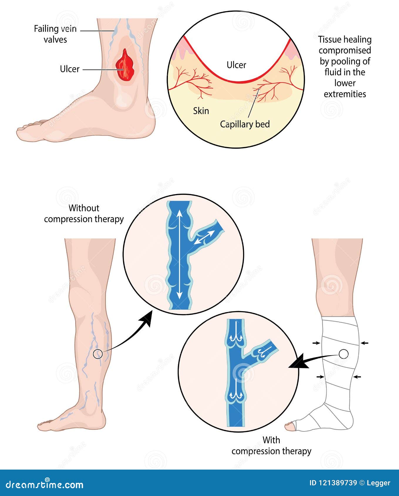 compression therapy for leg ulcers